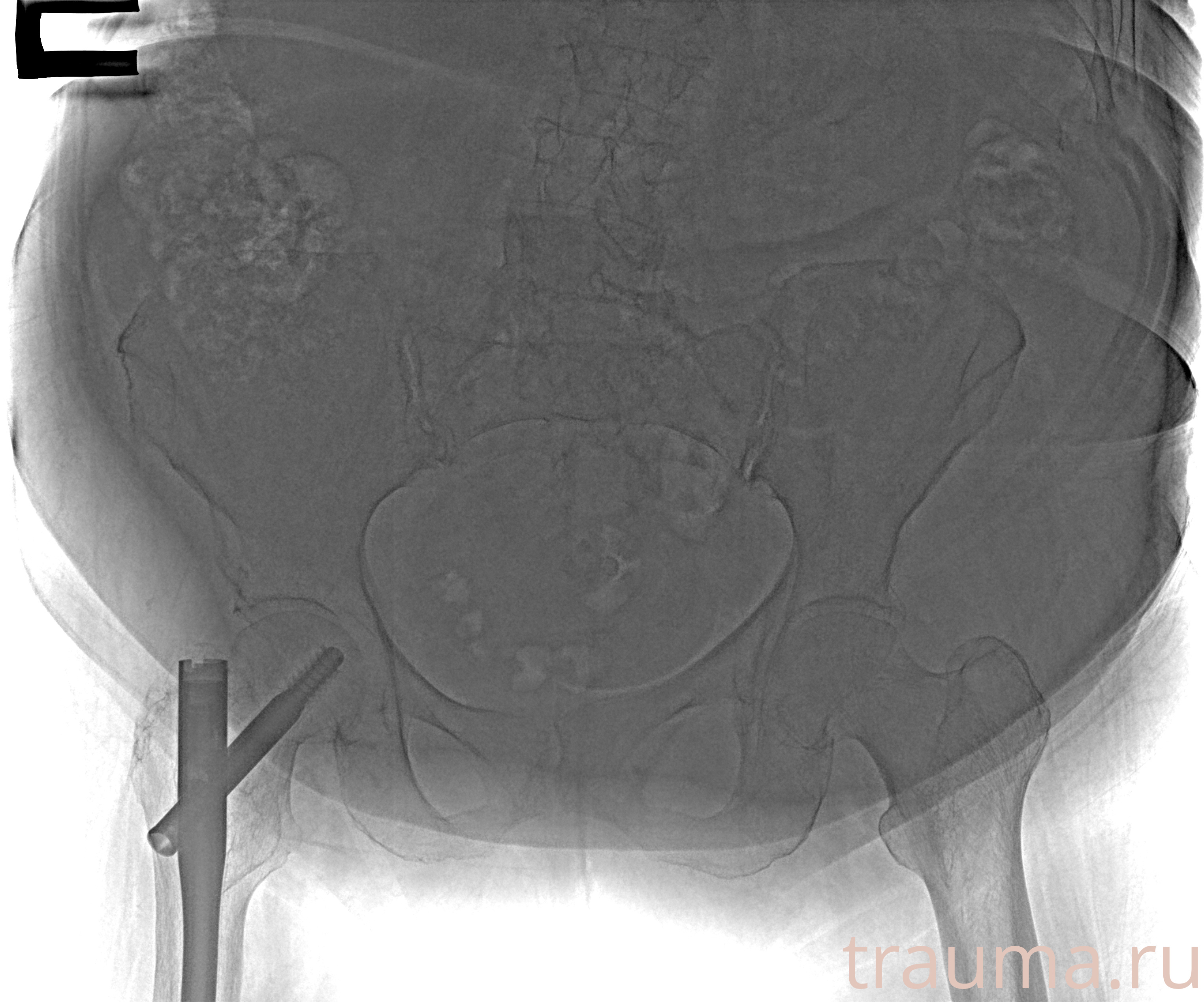 Рентген на дому: по вашему адресу приезжает врач-рентгенолог, травматолог-ортопед с мобильным рентгеновским аппаратом, проводит диагностику травмы или заболевания, делает необходимые рентгенограммы, дает рекомендации по дальнейшему лечению. Получить качественные снимки в домашних условиях возможно благодаря уникальной методике, разработанной МосРентген Центром для института  Склифосовского