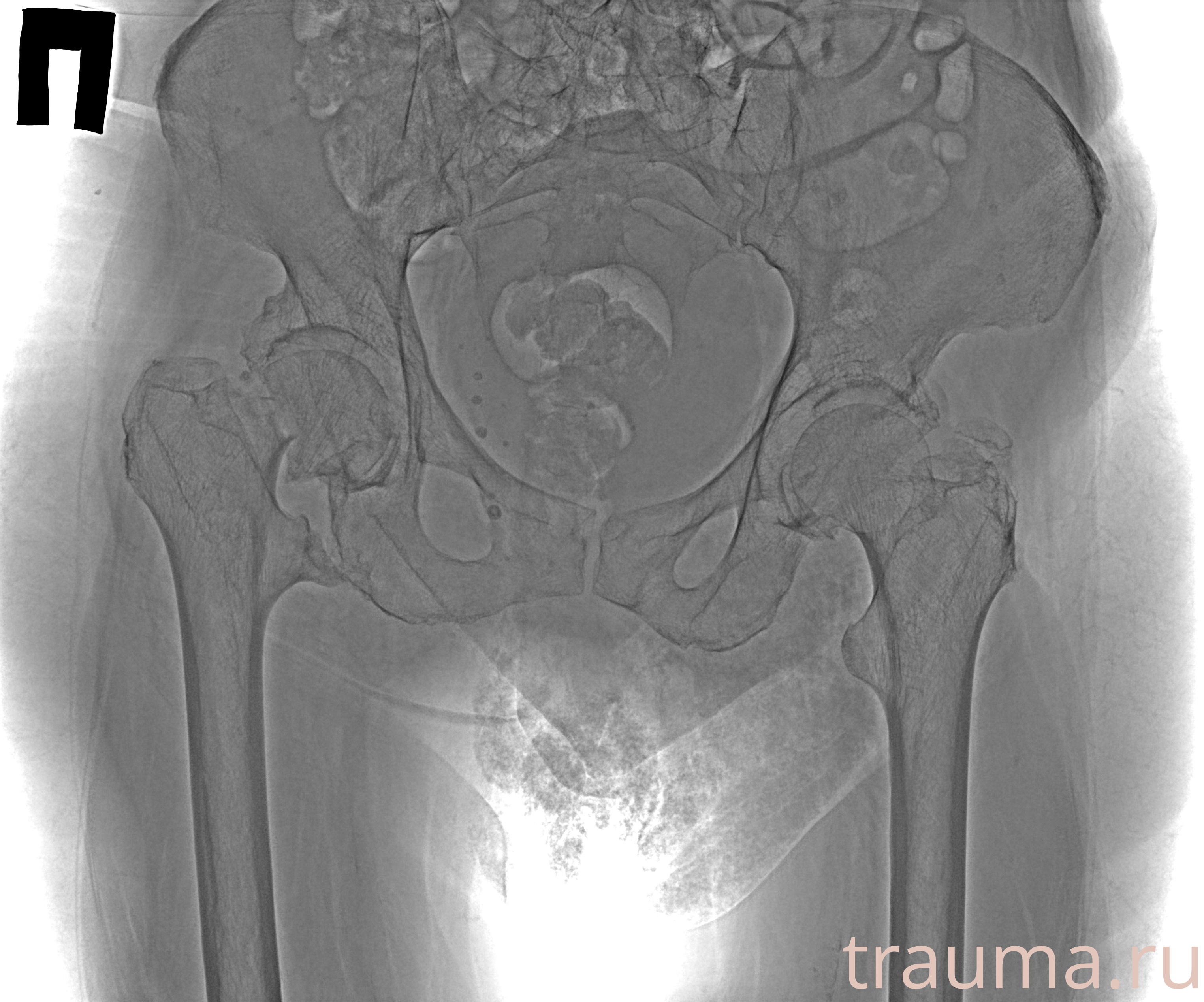 Рентген на дому: по вашему адресу приезжает врач-рентгенолог, травматолог-ортопед с мобильным рентгеновским аппаратом, проводит диагностику травмы или заболевания, делает необходимые рентгенограммы, дает рекомендации по дальнейшему лечению. Получить качественные снимки в домашних условиях возможно благодаря уникальной методике, разработанной МосРентген Центром для института  Склифосовского