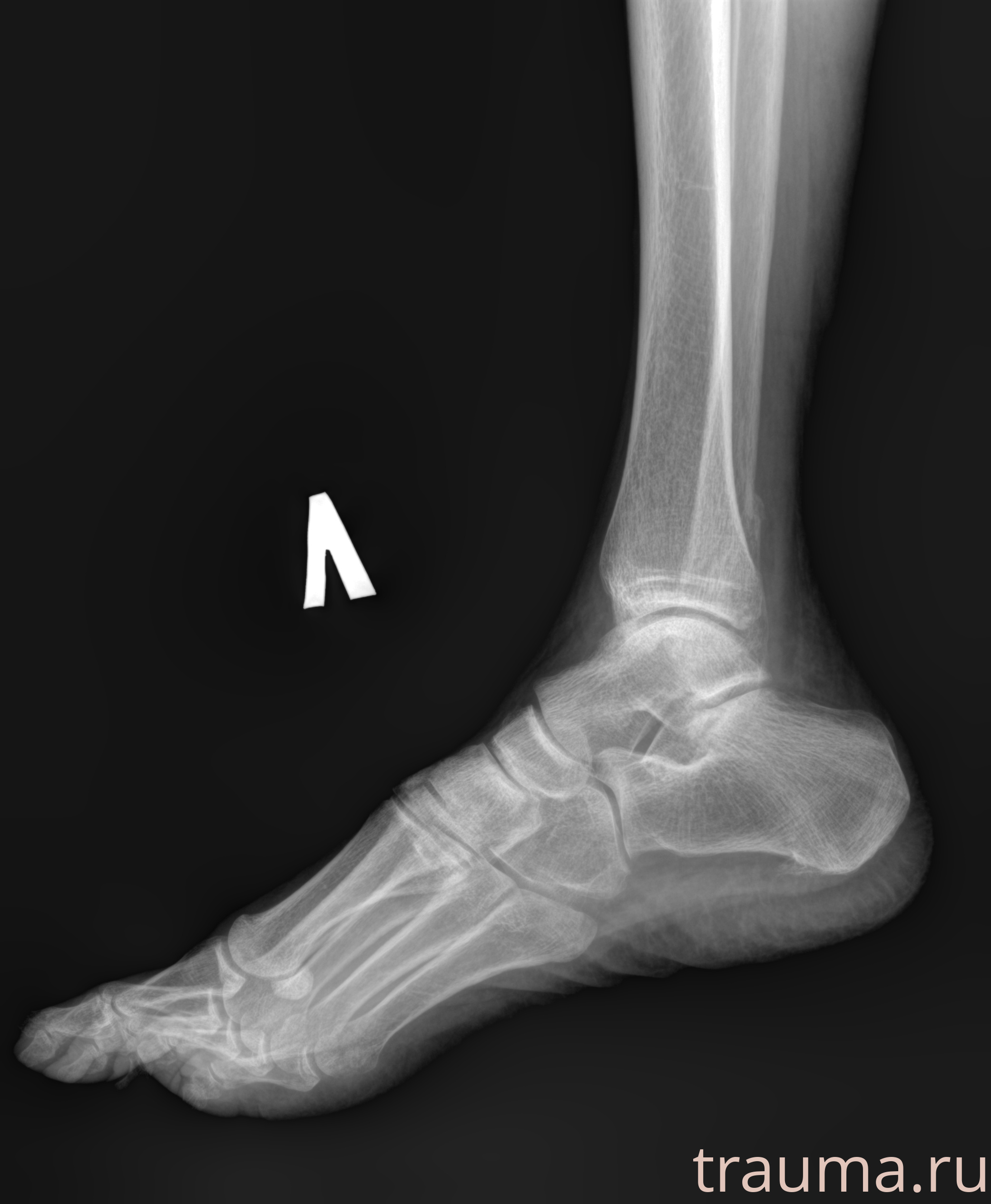 Рентген на дому: по вашему адресу приезжает врач-рентгенолог, травматолог-ортопед с мобильным рентгеновским аппаратом, проводит диагностику травмы или заболевания, делает необходимые рентгенограммы, дает рекомендации по дальнейшему лечению. Получить качественные снимки в домашних условиях возможно благодаря уникальной методике, разработанной МосРентген Центром для института  Склифосовского