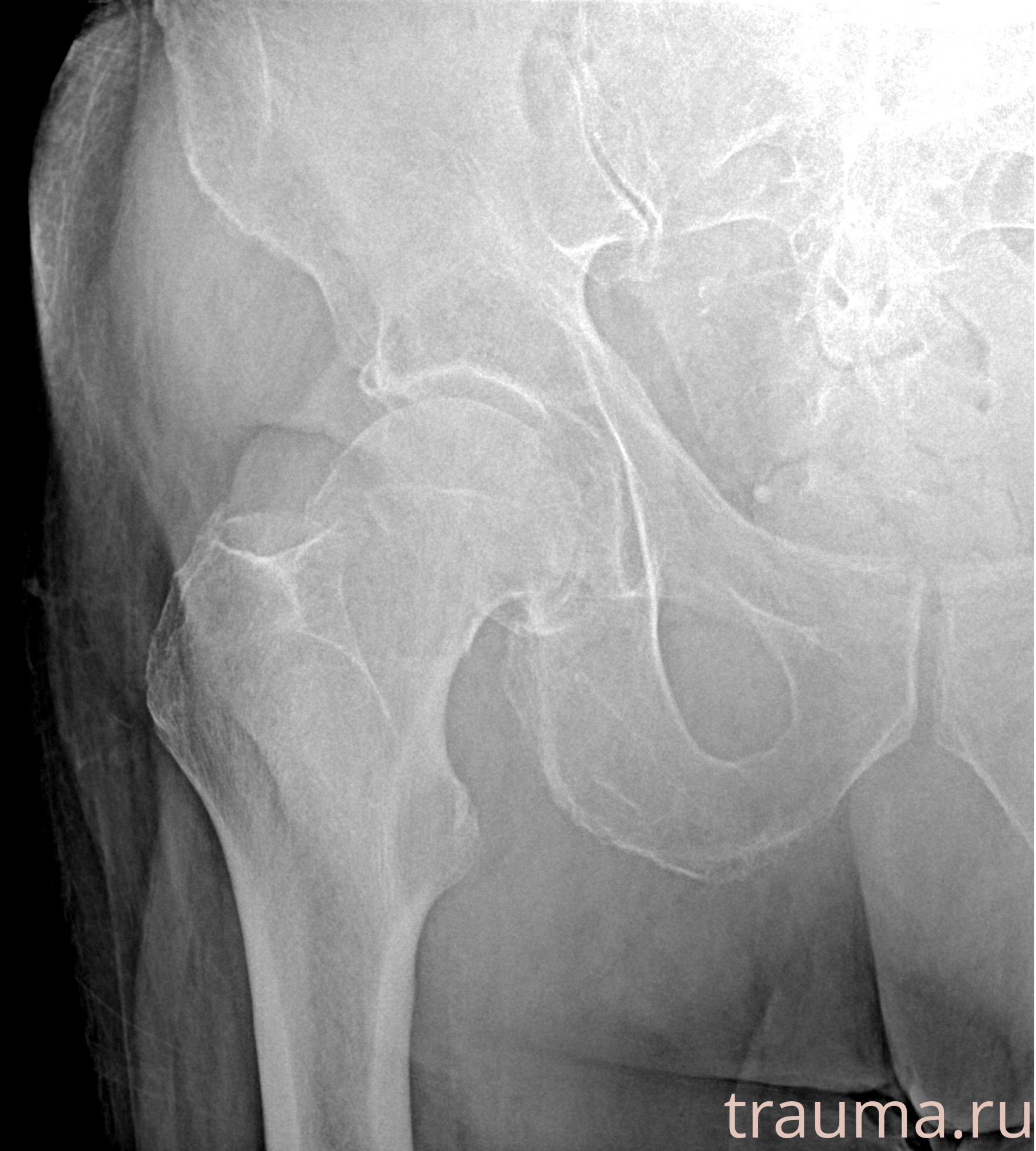 Рентген на дому: по вашему адресу приезжает врач-рентгенолог, травматолог-ортопед с мобильным рентгеновским аппаратом, проводит диагностику травмы или заболевания, делает необходимые рентгенограммы, дает рекомендации по дальнейшему лечению. Получить качественные снимки в домашних условиях возможно благодаря уникальной методике, разработанной МосРентген Центром для института  Склифосовского