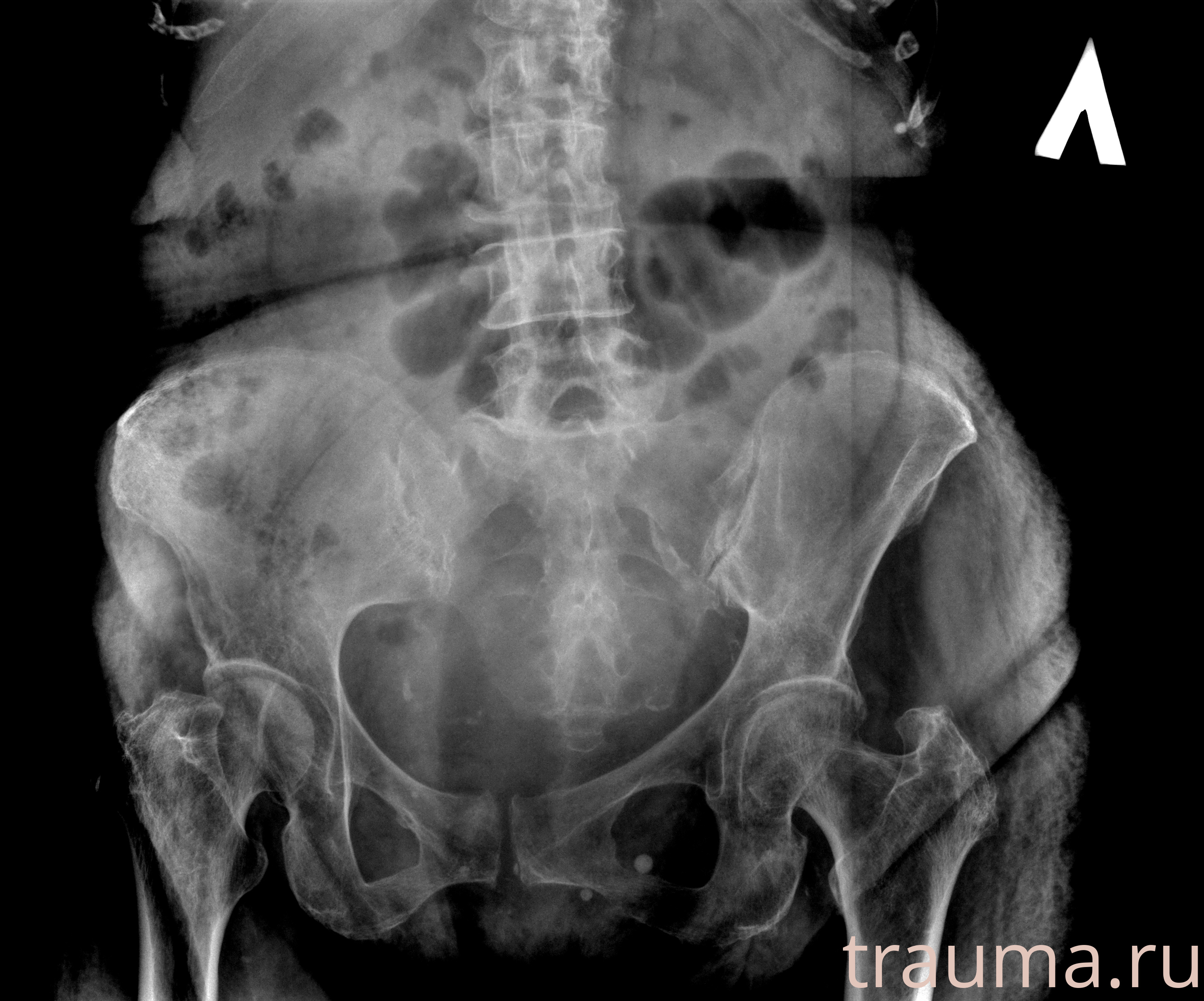 Рентген на дому: по вашему адресу приезжает врач-рентгенолог, травматолог-ортопед с мобильным рентгеновским аппаратом, проводит диагностику травмы или заболевания, делает необходимые рентгенограммы, дает рекомендации по дальнейшему лечению. Получить качественные снимки в домашних условиях возможно благодаря уникальной методике, разработанной МосРентген Центром для института  Склифосовского