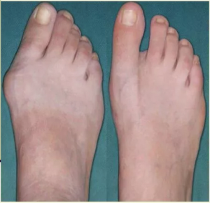 Клинико-исторические аспекты лечения HALLUX VALGUS (часть II) Клинико-исторические аспекты лечения HALLUX VALGUS (часть II)