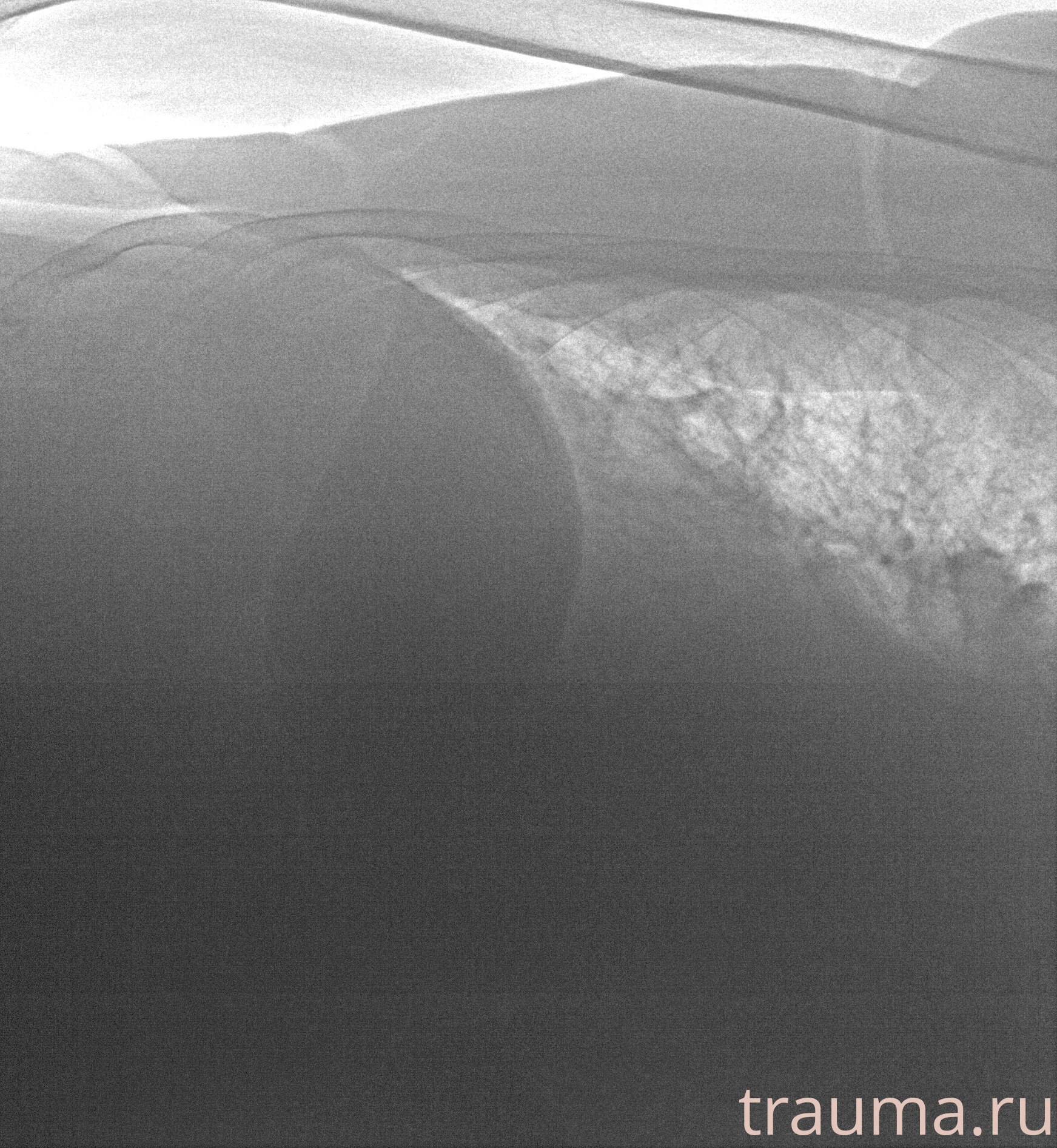 Рентген на дому: по вашему адресу приезжает врач-рентгенолог, травматолог-ортопед с мобильным рентгеновским аппаратом, проводит диагностику травмы или заболевания, делает необходимые рентгенограммы, дает рекомендации по дальнейшему лечению. Получить качественные снимки в домашних условиях возможно благодаря уникальной методике, разработанной МосРентген Центром для института  Склифосовского