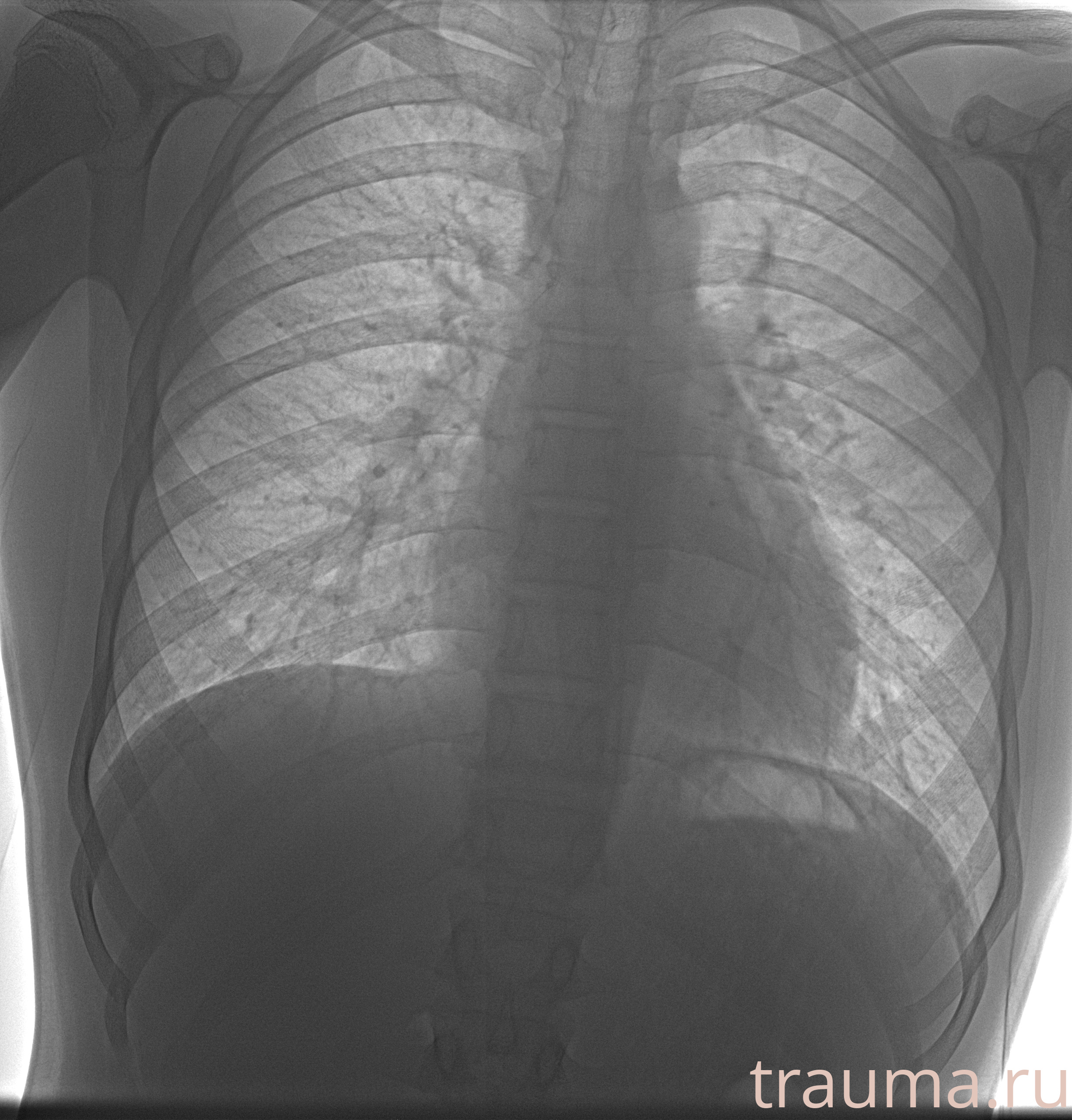 Рентген на дому: по вашему адресу приезжает врач-рентгенолог, травматолог-ортопед с мобильным рентгеновским аппаратом, проводит диагностику травмы или заболевания, делает необходимые рентгенограммы, дает рекомендации по дальнейшему лечению. Получить качественные снимки в домашних условиях возможно благодаря уникальной методике, разработанной МосРентген Центром для института  Склифосовского