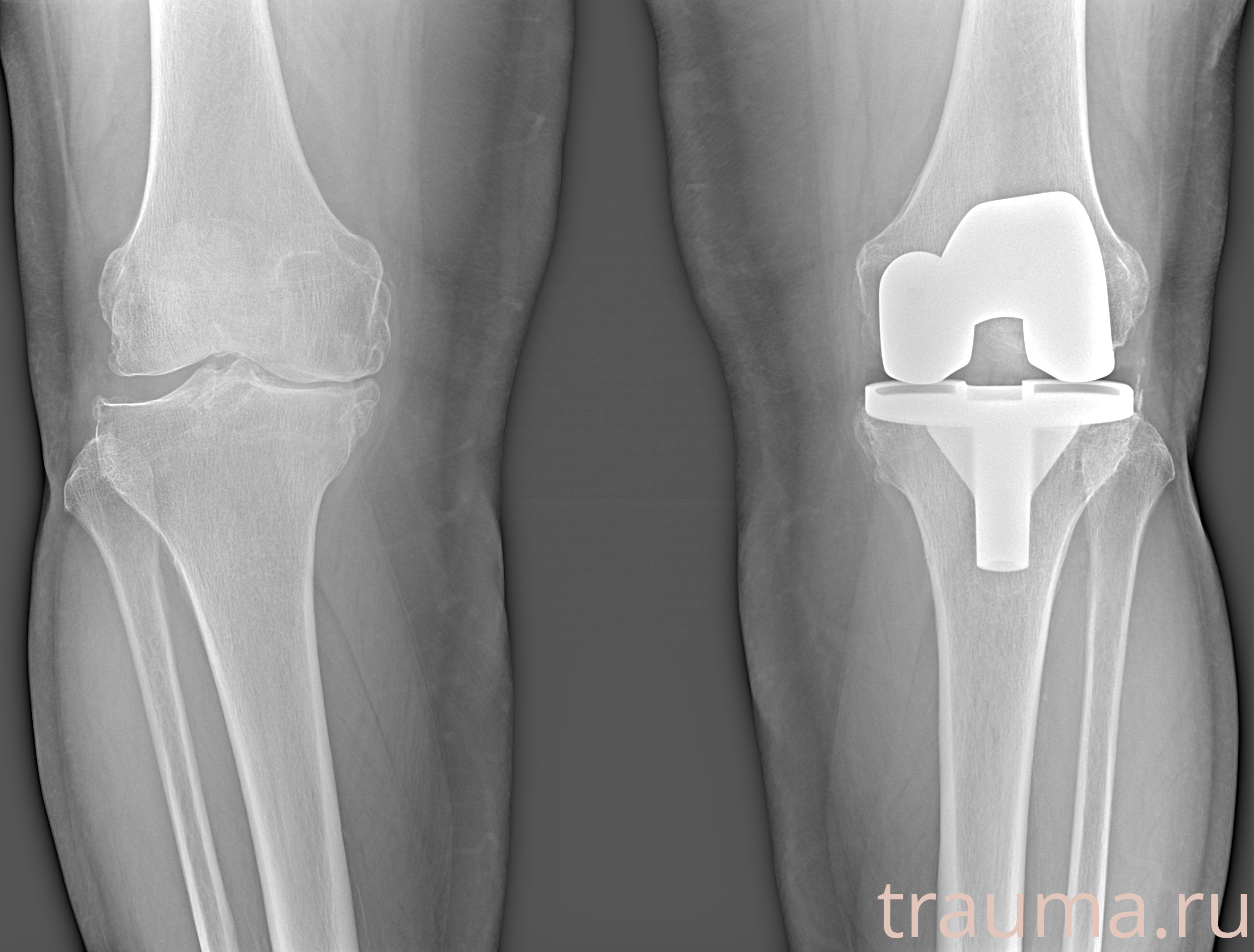 Рентген на дому: по вашему адресу приезжает врач-рентгенолог, травматолог-ортопед с мобильным рентгеновским аппаратом, проводит диагностику травмы или заболевания, делает необходимые рентгенограммы, дает рекомендации по дальнейшему лечению. Получить качественные снимки в домашних условиях возможно благодаря уникальной методике, разработанной МосРентген Центром для института  Склифосовского