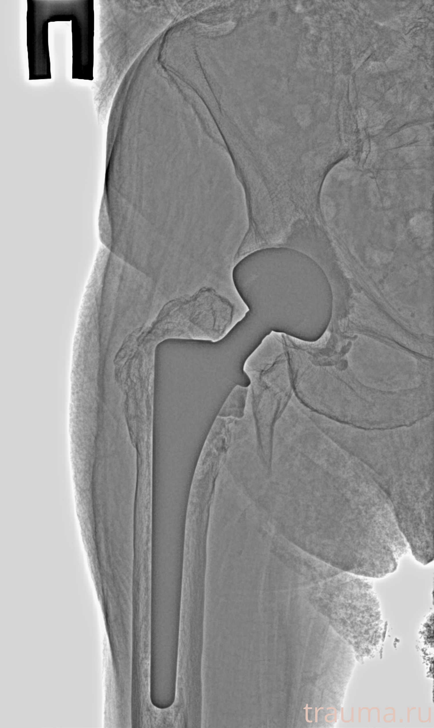 Рентген на дому: по вашему адресу приезжает врач-рентгенолог, травматолог-ортопед с мобильным рентгеновским аппаратом, проводит диагностику травмы или заболевания, делает необходимые рентгенограммы, дает рекомендации по дальнейшему лечению. Получить качественные снимки в домашних условиях возможно благодаря уникальной методике, разработанной МосРентген Центром для института  Склифосовского