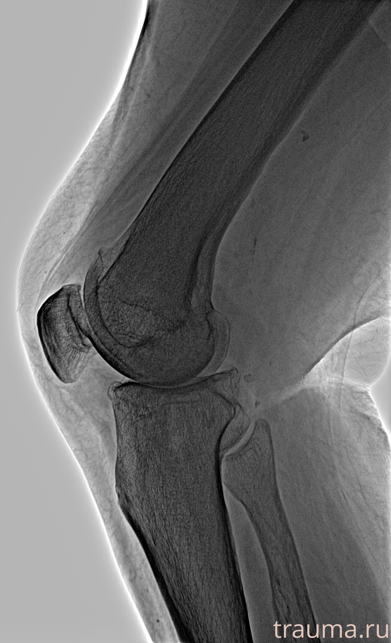 Рентген на дому: по вашему адресу приезжает врач-рентгенолог, травматолог-ортопед с мобильным рентгеновским аппаратом, проводит диагностику травмы или заболевания, делает необходимые рентгенограммы, дает рекомендации по дальнейшему лечению. Получить качественные снимки в домашних условиях возможно благодаря уникальной методике, разработанной МосРентген Центром для института  Склифосовского
