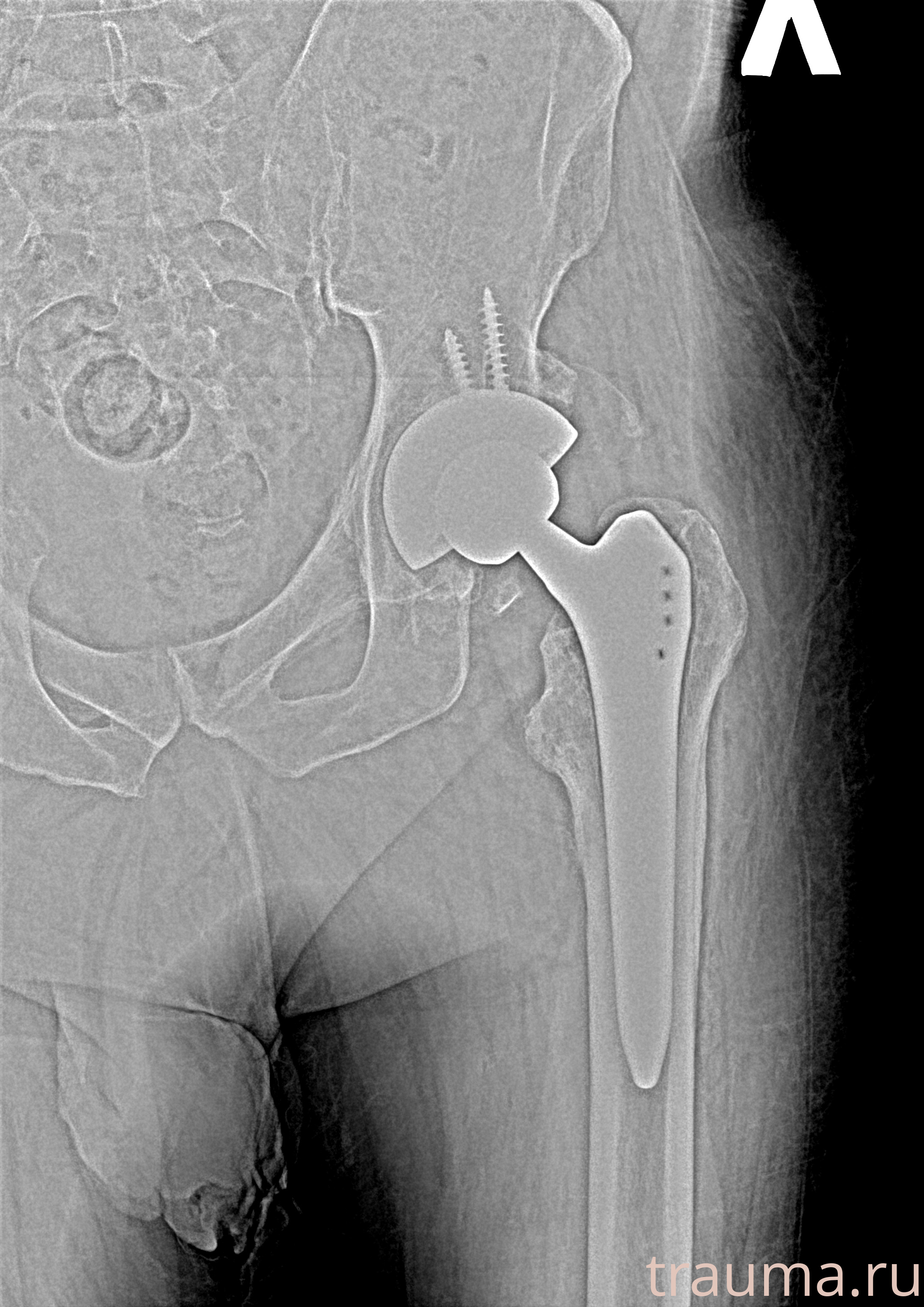 Рентген на дому: по вашему адресу приезжает врач-рентгенолог, травматолог-ортопед с мобильным рентгеновским аппаратом, проводит диагностику травмы или заболевания, делает необходимые рентгенограммы, дает рекомендации по дальнейшему лечению. Получить качественные снимки в домашних условиях возможно благодаря уникальной методике, разработанной МосРентген Центром для института  Склифосовского