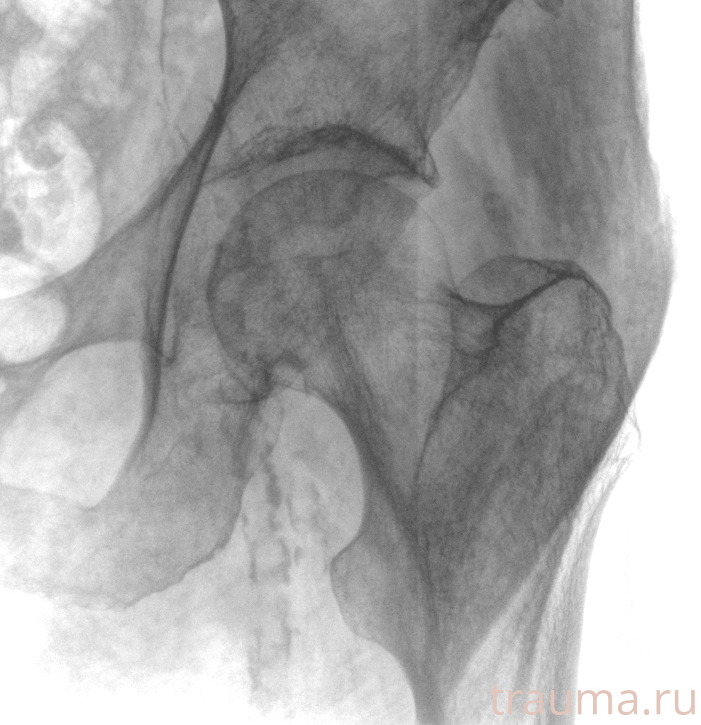 Рентген на дому: по вашему адресу приезжает врач-рентгенолог, травматолог-ортопед с мобильным рентгеновским аппаратом, проводит диагностику травмы или заболевания, делает необходимые рентгенограммы, дает рекомендации по дальнейшему лечению. Получить качественные снимки в домашних условиях возможно благодаря уникальной методике, разработанной МосРентген Центром для института  Склифосовского
