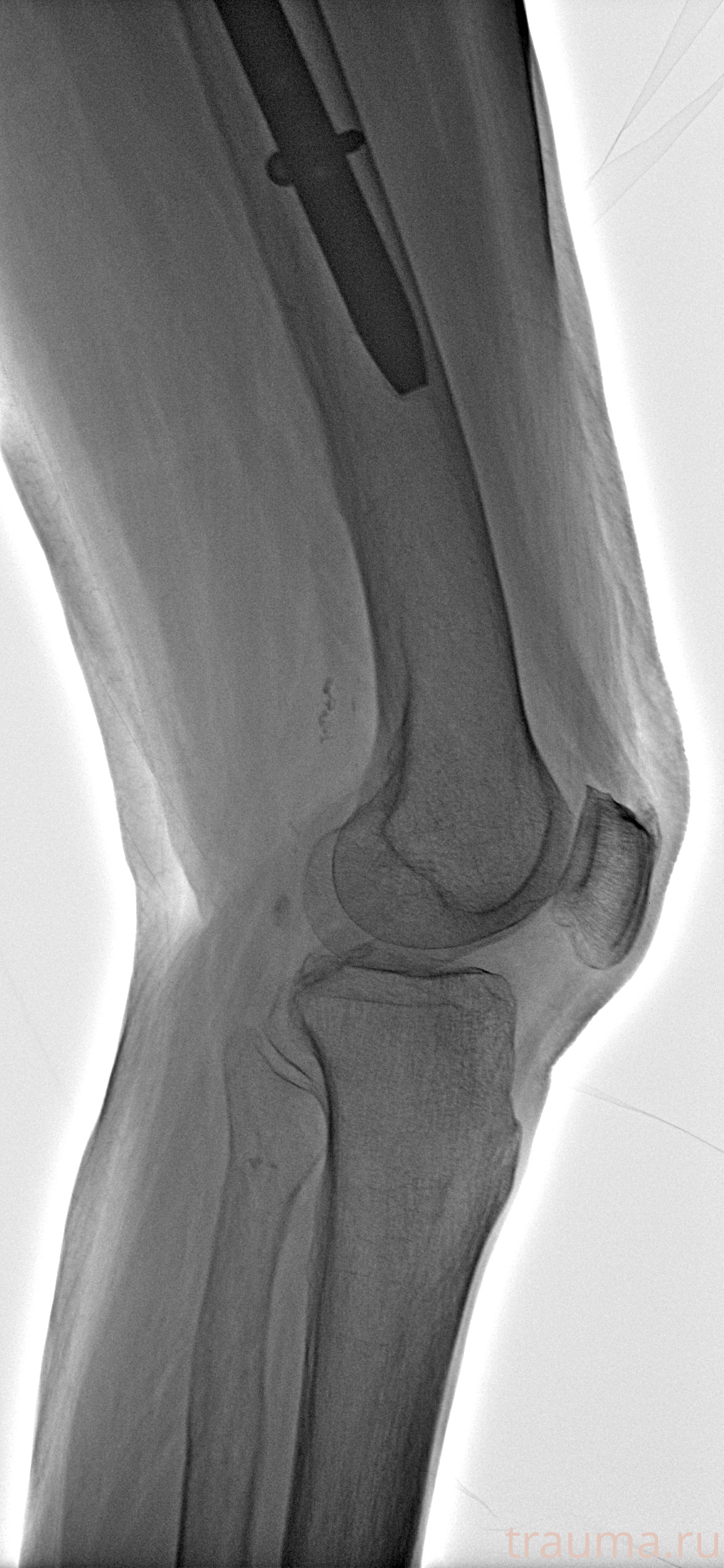 Рентген на дому: по вашему адресу приезжает врач-рентгенолог, травматолог-ортопед с мобильным рентгеновским аппаратом, проводит диагностику травмы или заболевания, делает необходимые рентгенограммы, дает рекомендации по дальнейшему лечению. Получить качественные снимки в домашних условиях возможно благодаря уникальной методике, разработанной МосРентген Центром для института  Склифосовского
