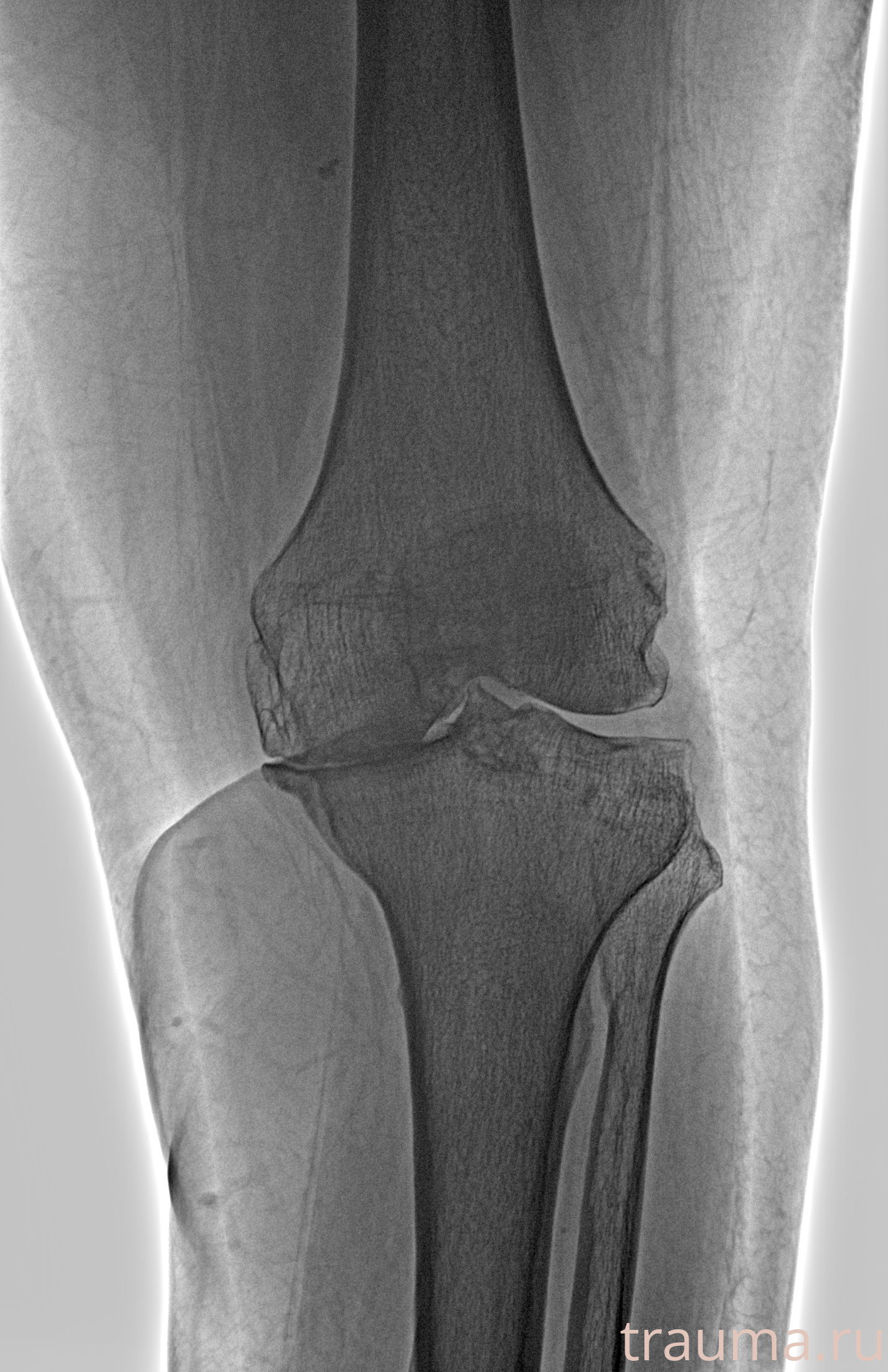 Рентген на дому: по вашему адресу приезжает врач-рентгенолог, травматолог-ортопед с мобильным рентгеновским аппаратом, проводит диагностику травмы или заболевания, делает необходимые рентгенограммы, дает рекомендации по дальнейшему лечению. Получить качественные снимки в домашних условиях возможно благодаря уникальной методике, разработанной МосРентген Центром для института  Склифосовского