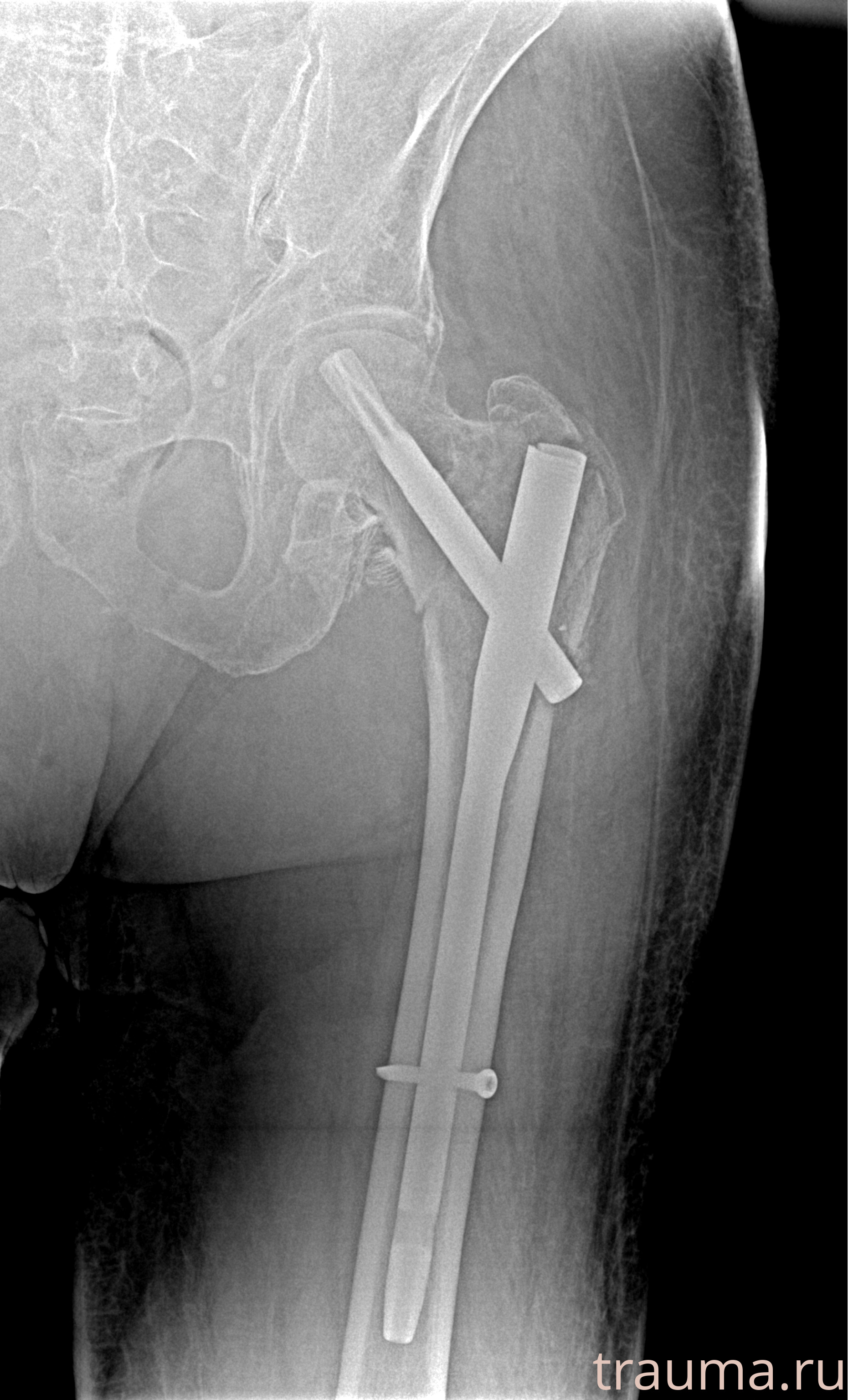 Рентген на дому: по вашему адресу приезжает врач-рентгенолог, травматолог-ортопед с мобильным рентгеновским аппаратом, проводит диагностику травмы или заболевания, делает необходимые рентгенограммы, дает рекомендации по дальнейшему лечению. Получить качественные снимки в домашних условиях возможно благодаря уникальной методике, разработанной МосРентген Центром для института  Склифосовского