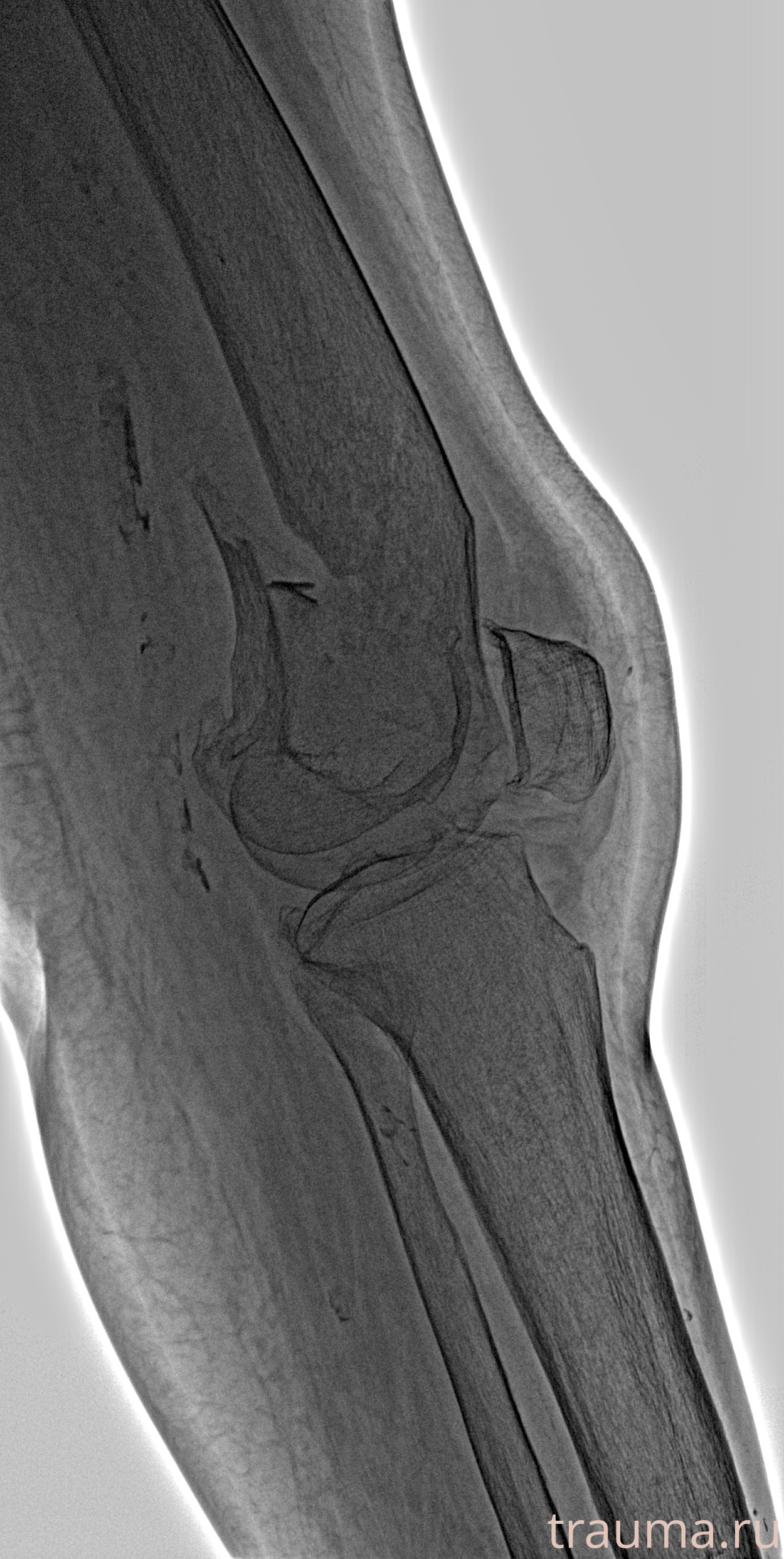 Рентген на дому: по вашему адресу приезжает врач-рентгенолог, травматолог-ортопед с мобильным рентгеновским аппаратом, проводит диагностику травмы или заболевания, делает необходимые рентгенограммы, дает рекомендации по дальнейшему лечению. Получить качественные снимки в домашних условиях возможно благодаря уникальной методике, разработанной МосРентген Центром для института  Склифосовского