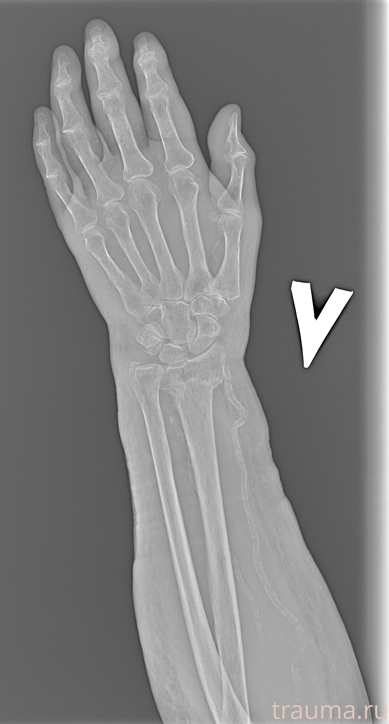 Рентген на дому: по вашему адресу приезжает врач-рентгенолог, травматолог-ортопед с мобильным рентгеновским аппаратом, проводит диагностику травмы или заболевания, делает необходимые рентгенограммы, дает рекомендации по дальнейшему лечению. Получить качественные снимки в домашних условиях возможно благодаря уникальной методике, разработанной МосРентген Центром для института  Склифосовского