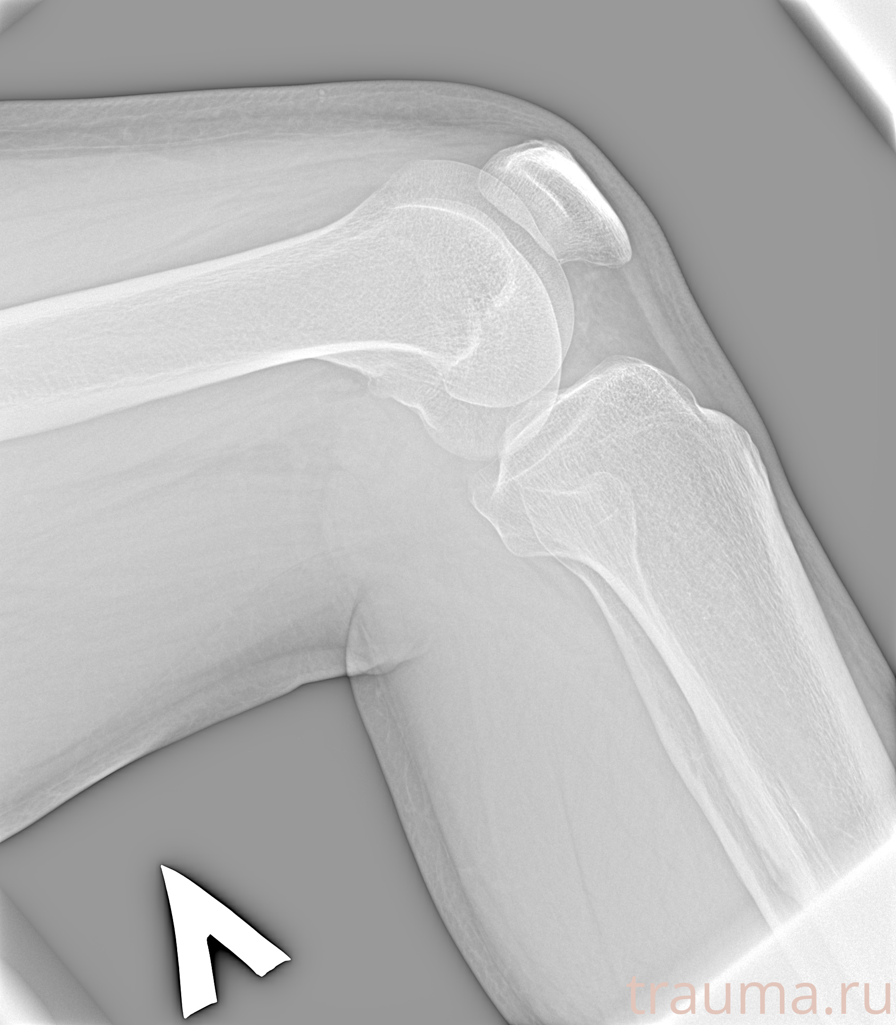 Рентген на дому: по вашему адресу приезжает врач-рентгенолог, травматолог-ортопед с мобильным рентгеновским аппаратом, проводит диагностику травмы или заболевания, делает необходимые рентгенограммы, дает рекомендации по дальнейшему лечению. Получить качественные снимки в домашних условиях возможно благодаря уникальной методике, разработанной МосРентген Центром для института  Склифосовского