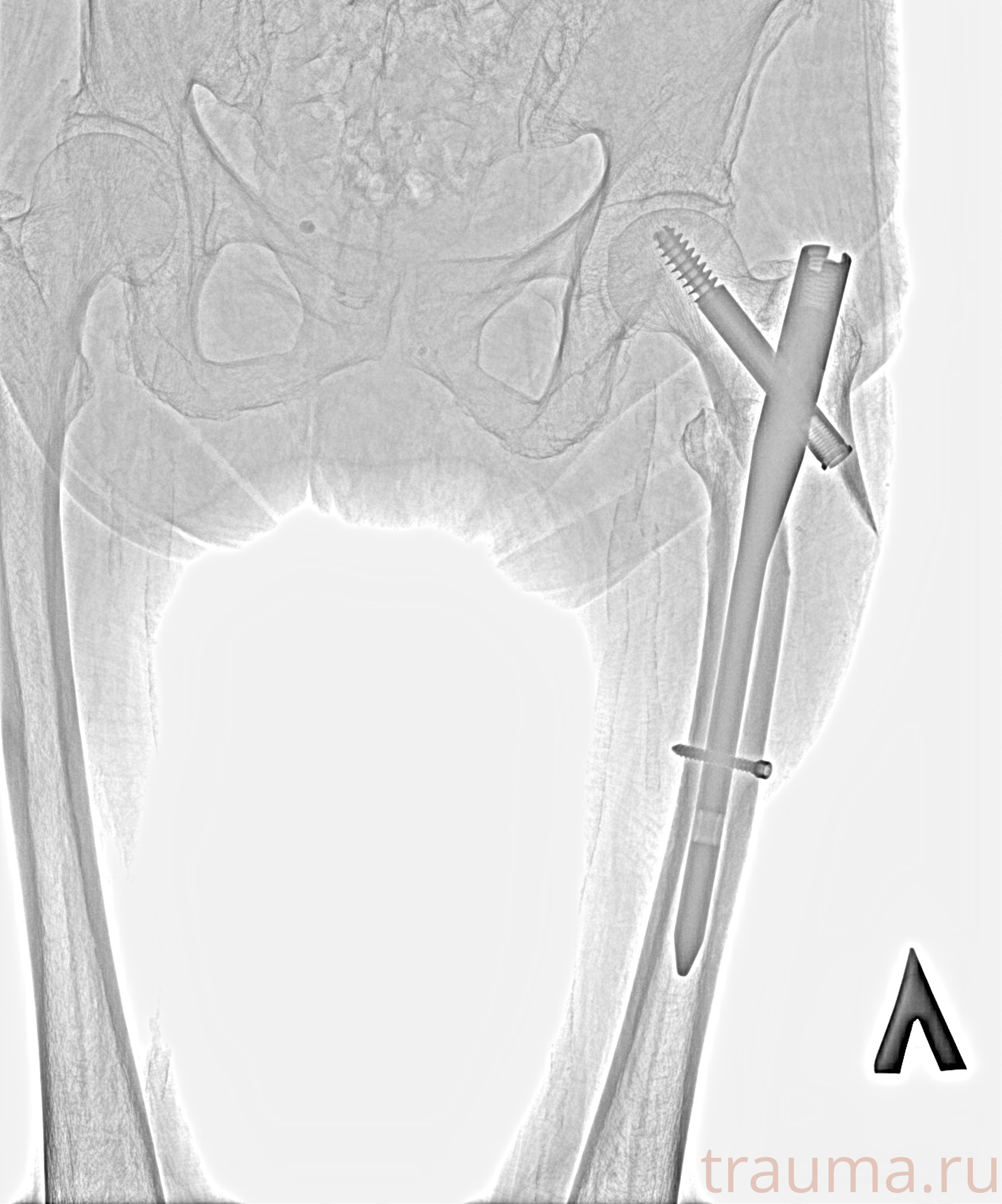 Рентген на дому: по вашему адресу приезжает врач-рентгенолог, травматолог-ортопед с мобильным рентгеновским аппаратом, проводит диагностику травмы или заболевания, делает необходимые рентгенограммы, дает рекомендации по дальнейшему лечению. Получить качественные снимки в домашних условиях возможно благодаря уникальной методике, разработанной МосРентген Центром для института  Склифосовского
