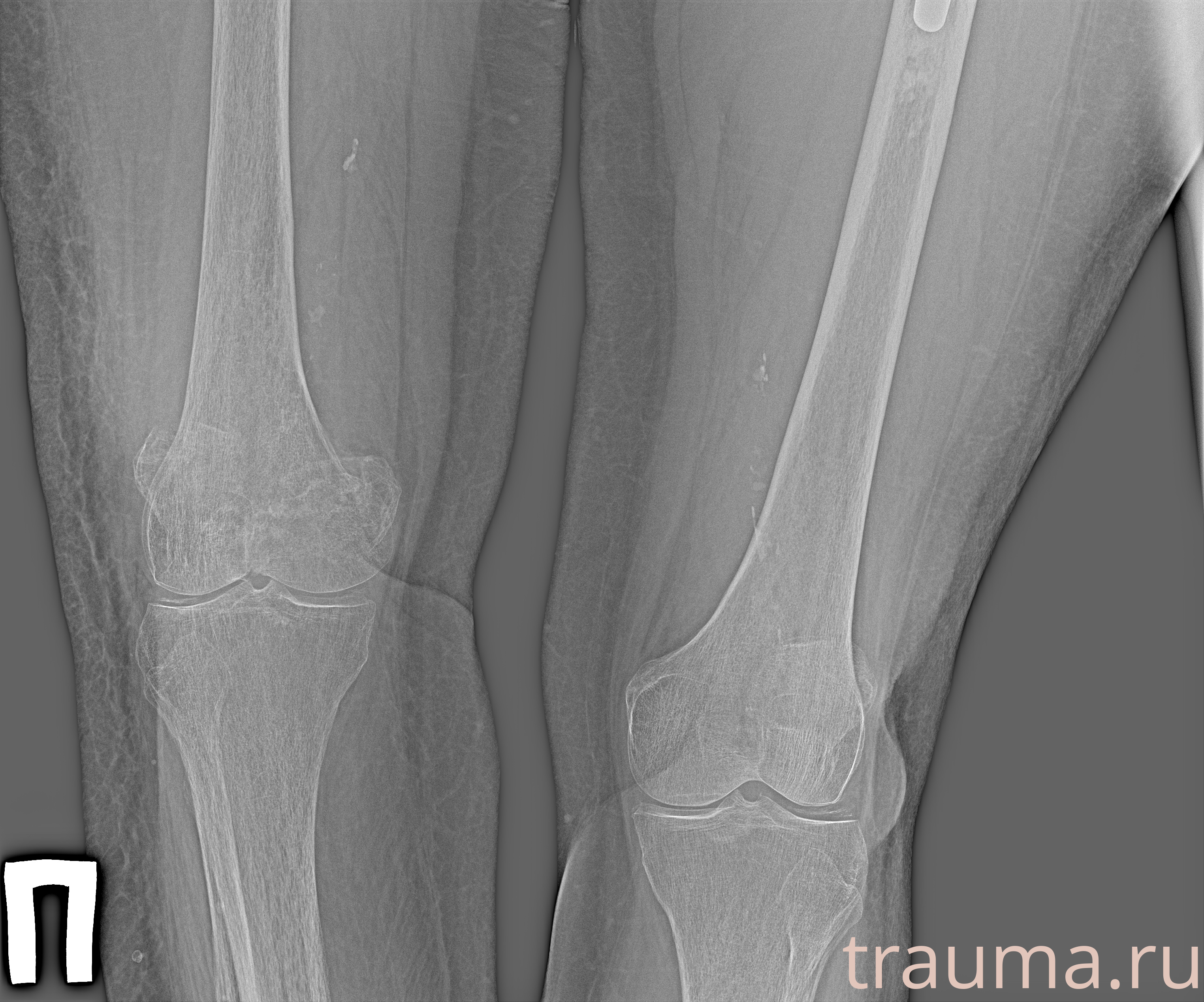 Рентген на дому: по вашему адресу приезжает врач-рентгенолог, травматолог-ортопед с мобильным рентгеновским аппаратом, проводит диагностику травмы или заболевания, делает необходимые рентгенограммы, дает рекомендации по дальнейшему лечению. Получить качественные снимки в домашних условиях возможно благодаря уникальной методике, разработанной МосРентген Центром для института  Склифосовского
