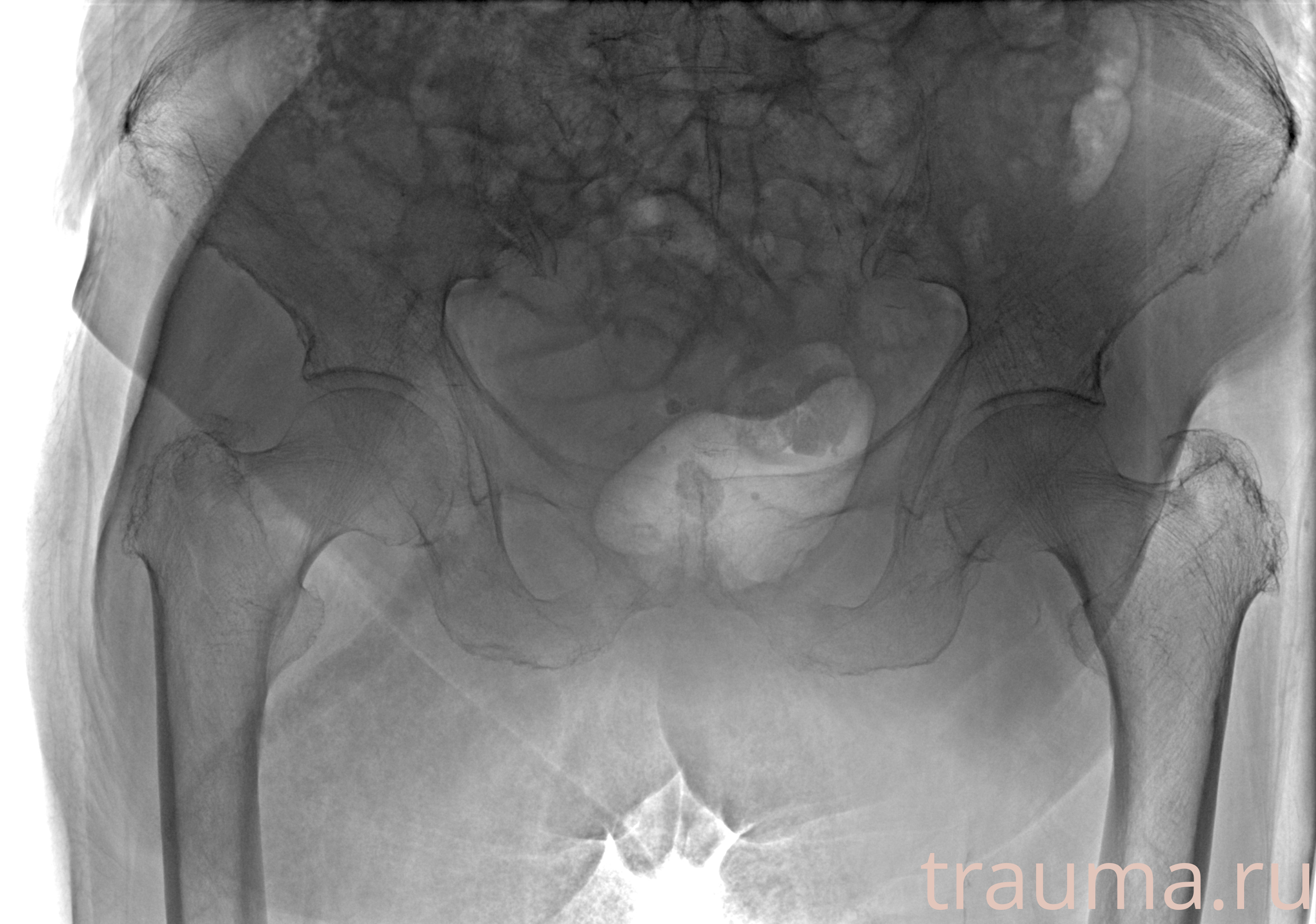 Рентген на дому: по вашему адресу приезжает врач-рентгенолог, травматолог-ортопед с мобильным рентгеновским аппаратом, проводит диагностику травмы или заболевания, делает необходимые рентгенограммы, дает рекомендации по дальнейшему лечению. Получить качественные снимки в домашних условиях возможно благодаря уникальной методике, разработанной МосРентген Центром для института  Склифосовского