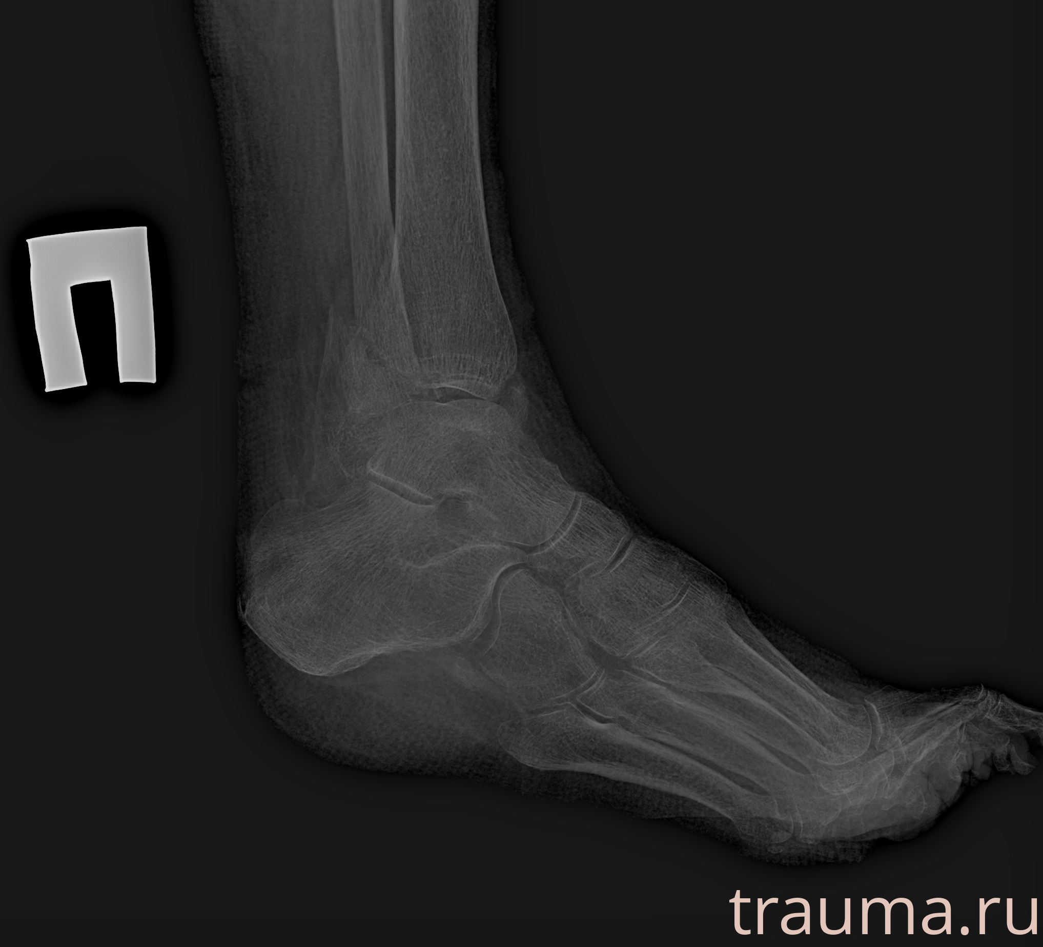 Рентген на дому: по вашему адресу приезжает врач-рентгенолог, травматолог-ортопед с мобильным рентгеновским аппаратом, проводит диагностику травмы или заболевания, делает необходимые рентгенограммы, дает рекомендации по дальнейшему лечению. Получить качественные снимки в домашних условиях возможно благодаря уникальной методике, разработанной МосРентген Центром для института  Склифосовского