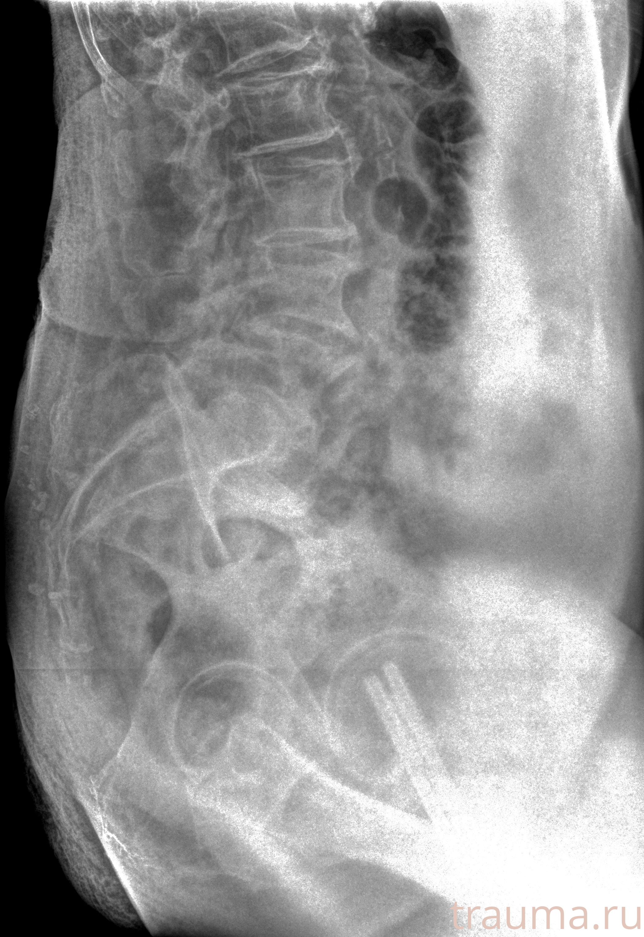 Рентген на дому: по вашему адресу приезжает врач-рентгенолог, травматолог-ортопед с мобильным рентгеновским аппаратом, проводит диагностику травмы или заболевания, делает необходимые рентгенограммы, дает рекомендации по дальнейшему лечению. Получить качественные снимки в домашних условиях возможно благодаря уникальной методике, разработанной МосРентген Центром для института  Склифосовского