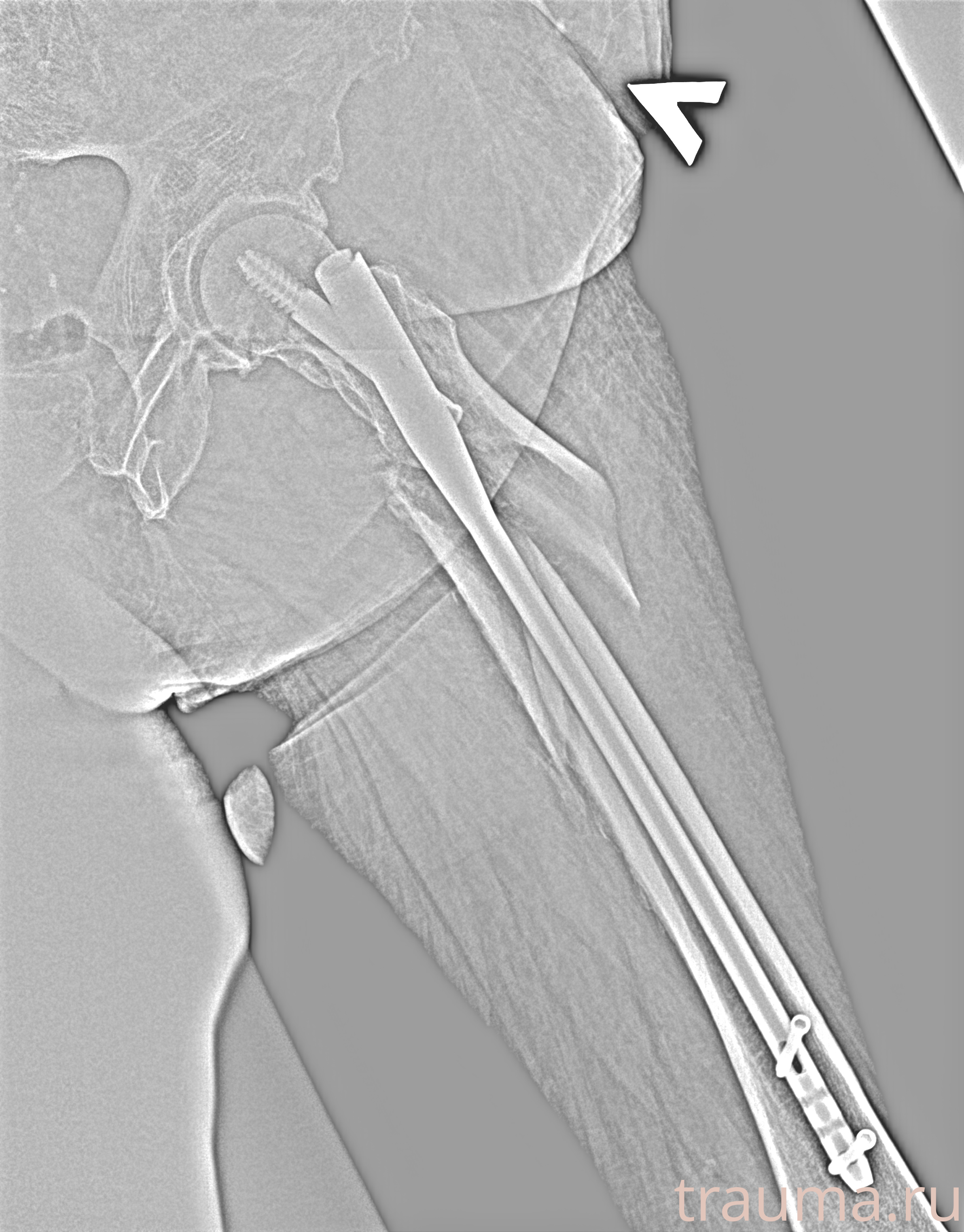 Рентген на дому: по вашему адресу приезжает врач-рентгенолог, травматолог-ортопед с мобильным рентгеновским аппаратом, проводит диагностику травмы или заболевания, делает необходимые рентгенограммы, дает рекомендации по дальнейшему лечению. Получить качественные снимки в домашних условиях возможно благодаря уникальной методике, разработанной МосРентген Центром для института  Склифосовского