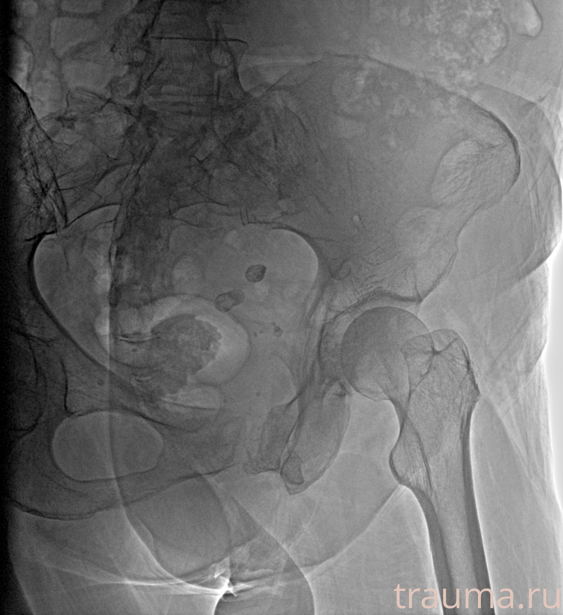 Рентген на дому: по вашему адресу приезжает врач-рентгенолог, травматолог-ортопед с мобильным рентгеновским аппаратом, проводит диагностику травмы или заболевания, делает необходимые рентгенограммы, дает рекомендации по дальнейшему лечению. Получить качественные снимки в домашних условиях возможно благодаря уникальной методике, разработанной МосРентген Центром для института  Склифосовского