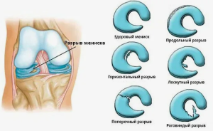 Повреждение мениска коленного сустава Повреждение мениска коленного сустава