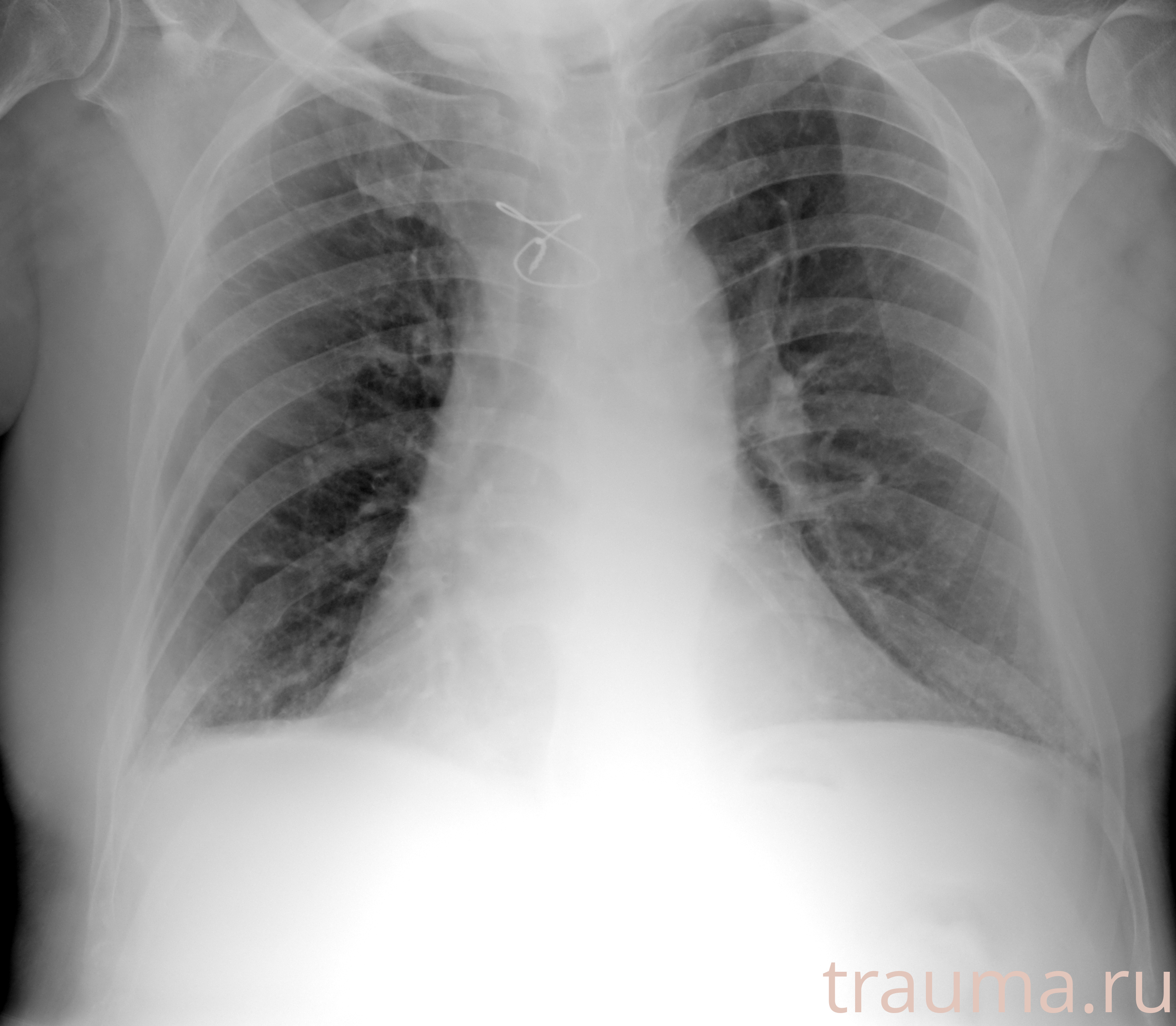 Рентген на дому: по вашему адресу приезжает врач-рентгенолог, травматолог-ортопед с мобильным рентгеновским аппаратом, проводит диагностику травмы или заболевания, делает необходимые рентгенограммы, дает рекомендации по дальнейшему лечению. Получить качественные снимки в домашних условиях возможно благодаря уникальной методике, разработанной МосРентген Центром для института  Склифосовского