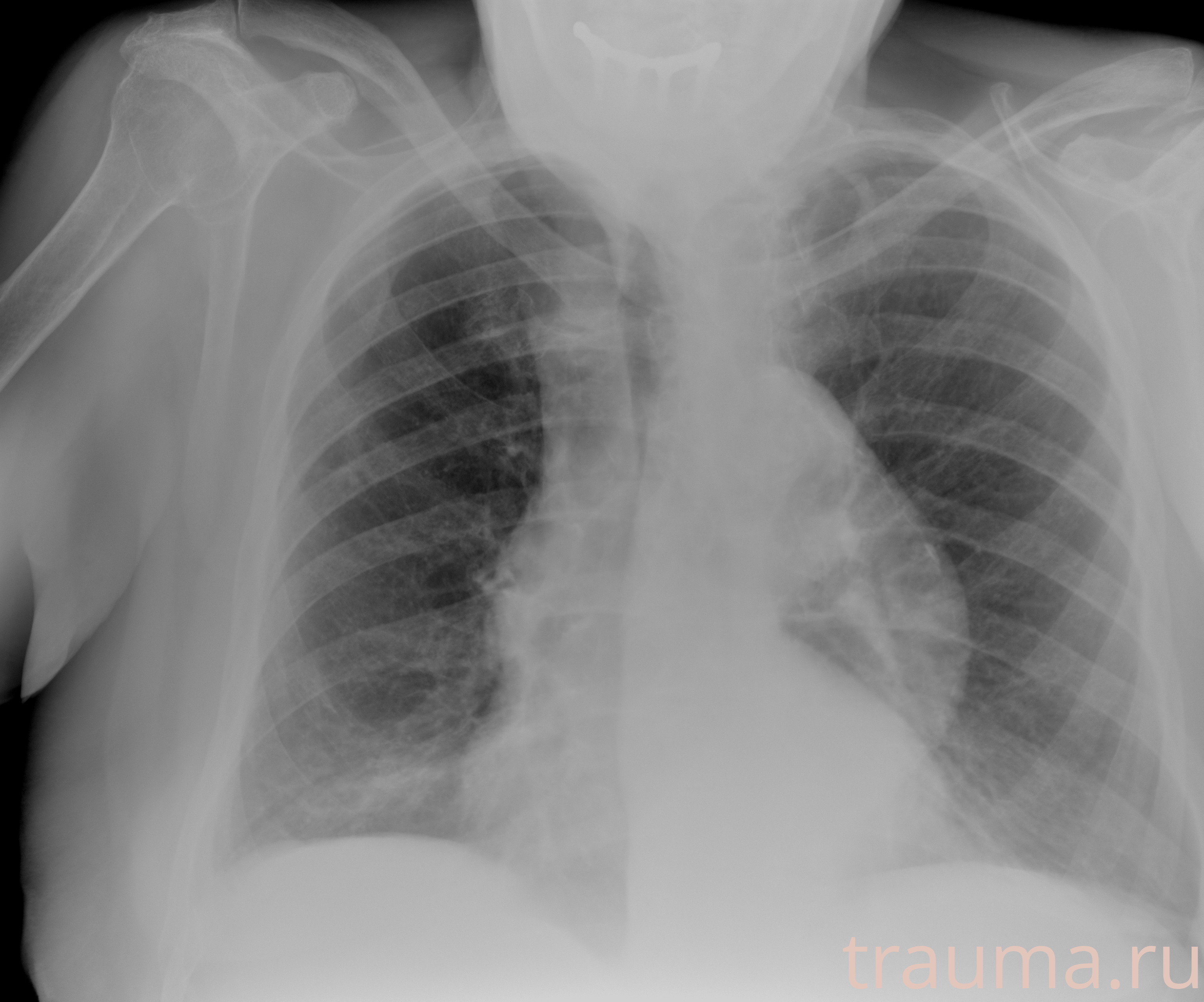 Рентген на дому: по вашему адресу приезжает врач-рентгенолог, травматолог-ортопед с мобильным рентгеновским аппаратом, проводит диагностику травмы или заболевания, делает необходимые рентгенограммы, дает рекомендации по дальнейшему лечению. Получить качественные снимки в домашних условиях возможно благодаря уникальной методике, разработанной МосРентген Центром для института  Склифосовского