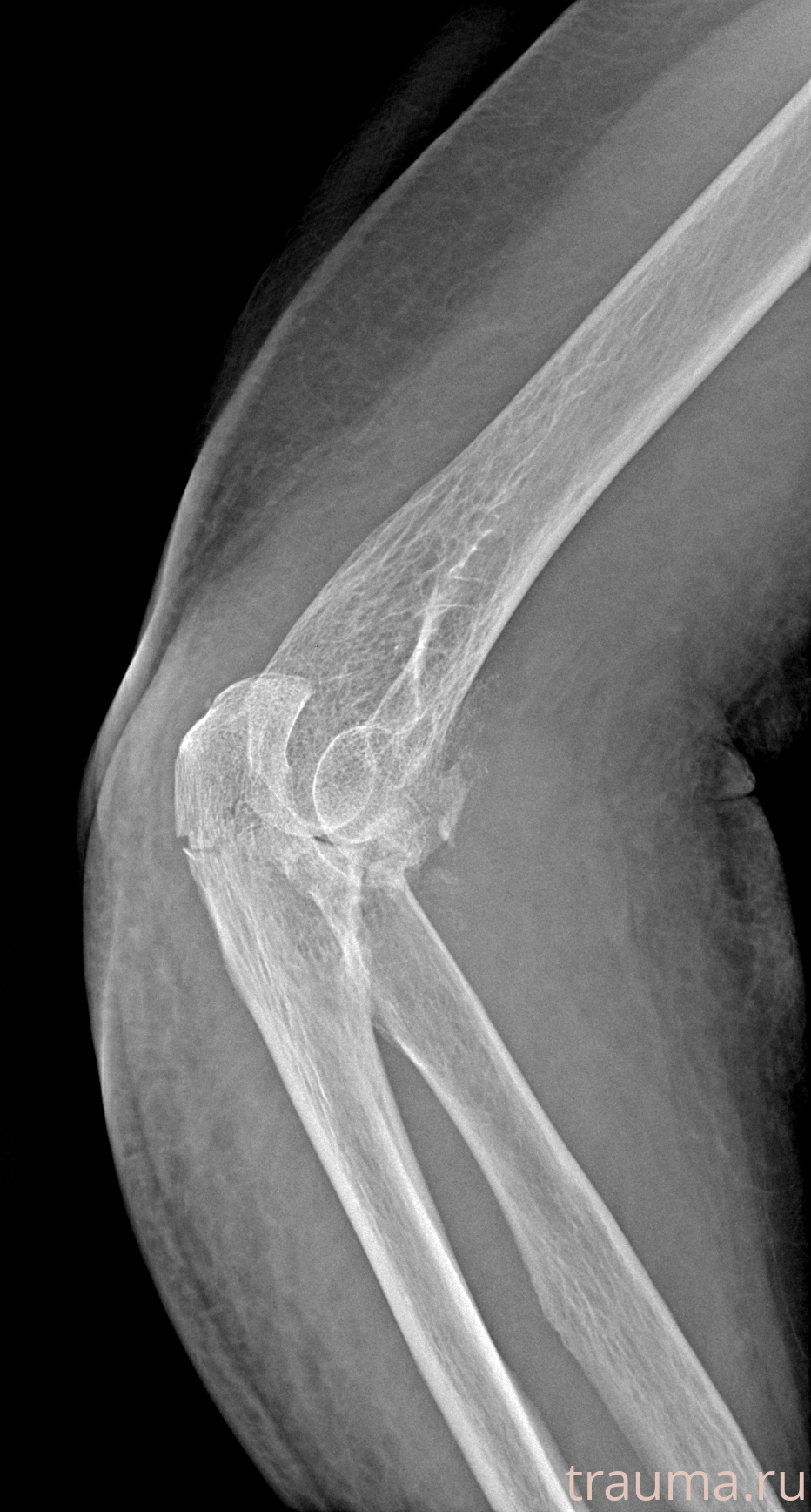 Рентген на дому: по вашему адресу приезжает врач-рентгенолог, травматолог-ортопед с мобильным рентгеновским аппаратом, проводит диагностику травмы или заболевания, делает необходимые рентгенограммы, дает рекомендации по дальнейшему лечению. Получить качественные снимки в домашних условиях возможно благодаря уникальной методике, разработанной МосРентген Центром для института  Склифосовского