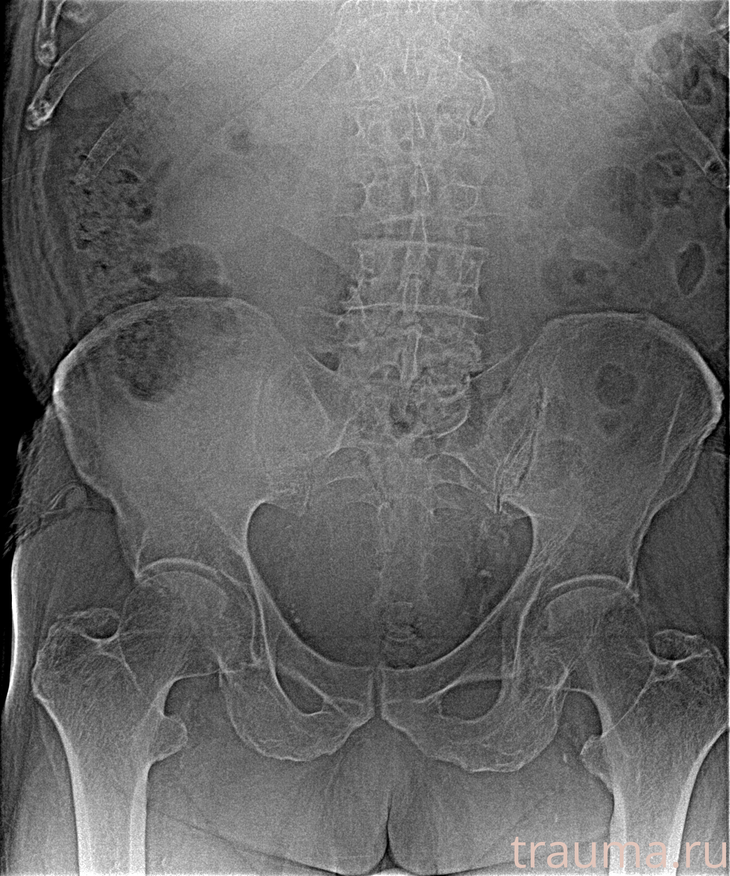 Рентген на дому: по вашему адресу приезжает врач-рентгенолог, травматолог-ортопед с мобильным рентгеновским аппаратом, проводит диагностику травмы или заболевания, делает необходимые рентгенограммы, дает рекомендации по дальнейшему лечению. Получить качественные снимки в домашних условиях возможно благодаря уникальной методике, разработанной МосРентген Центром для института  Склифосовского