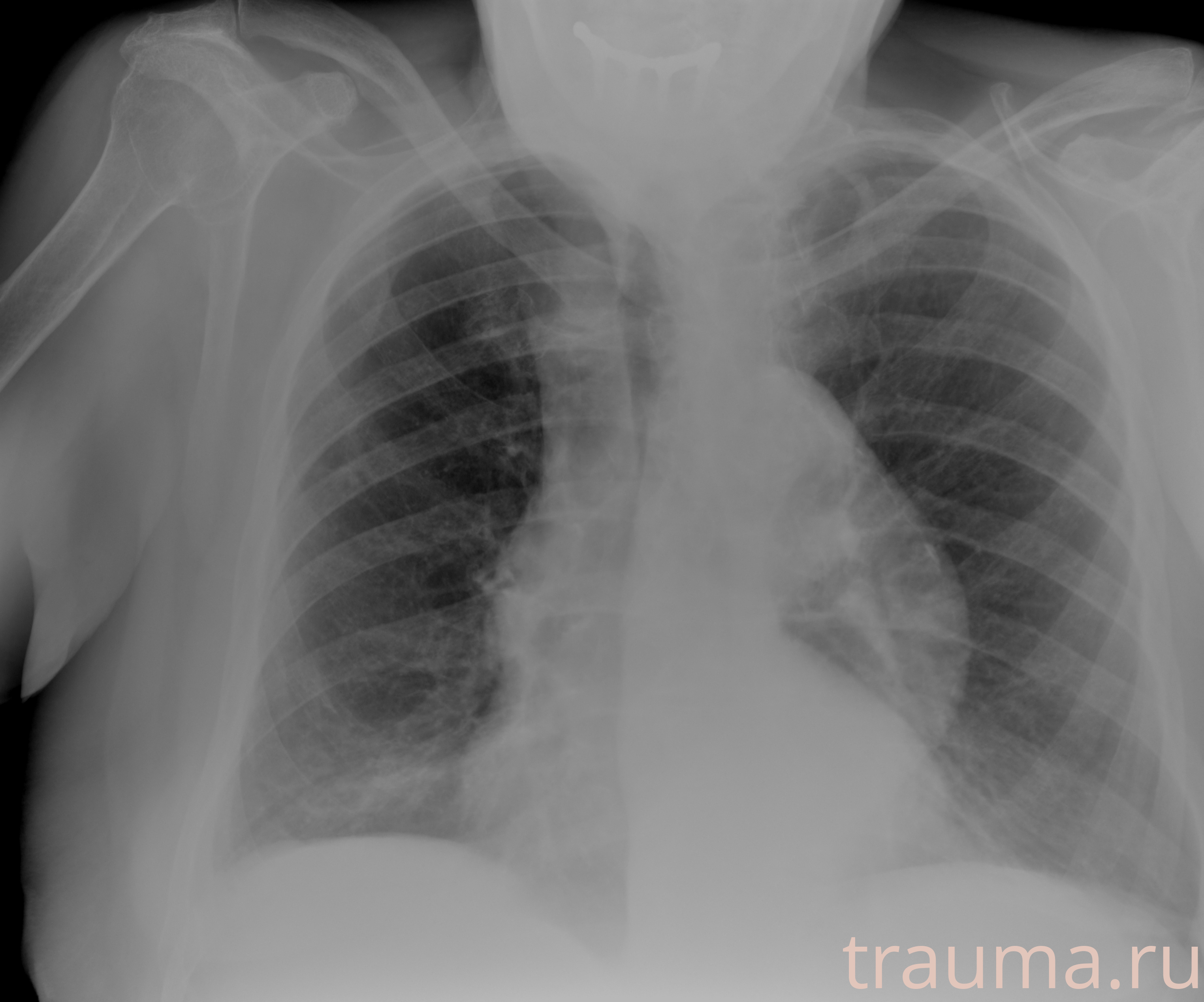 Рентген на дому: по вашему адресу приезжает врач-рентгенолог, травматолог-ортопед с мобильным рентгеновским аппаратом, проводит диагностику травмы или заболевания, делает необходимые рентгенограммы, дает рекомендации по дальнейшему лечению. Получить качественные снимки в домашних условиях возможно благодаря уникальной методике, разработанной МосРентген Центром для института  Склифосовского