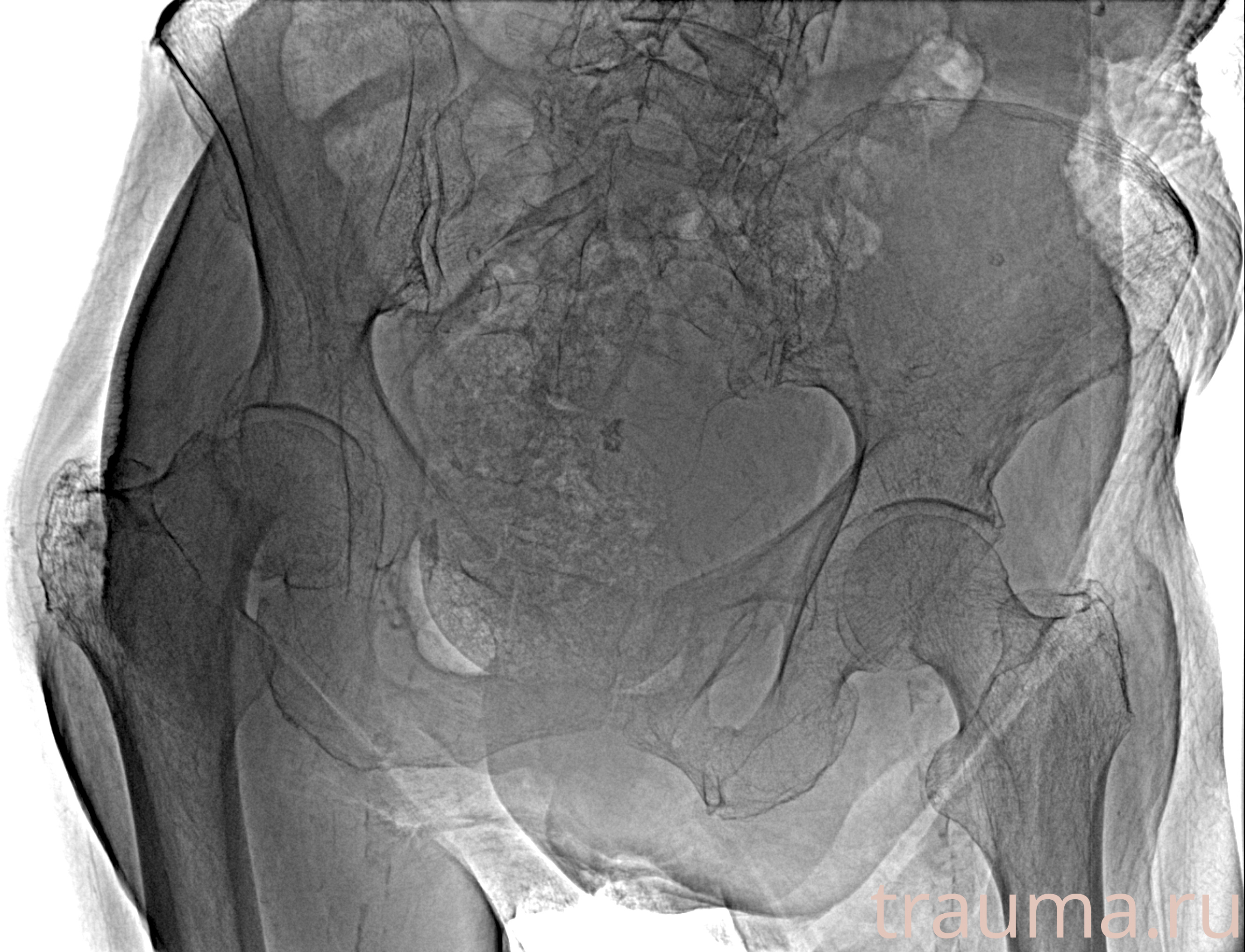 Рентген на дому: по вашему адресу приезжает врач-рентгенолог, травматолог-ортопед с мобильным рентгеновским аппаратом, проводит диагностику травмы или заболевания, делает необходимые рентгенограммы, дает рекомендации по дальнейшему лечению. Получить качественные снимки в домашних условиях возможно благодаря уникальной методике, разработанной МосРентген Центром для института  Склифосовского
