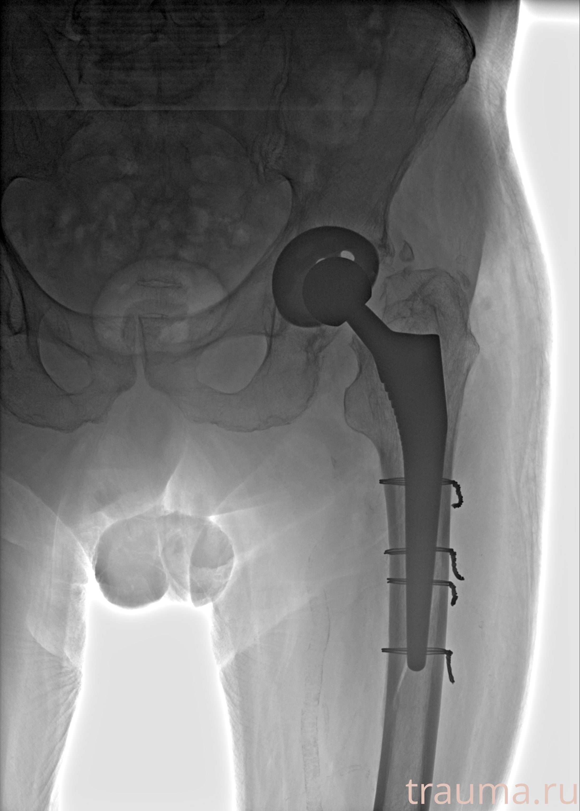 Рентген на дому: по вашему адресу приезжает врач-рентгенолог, травматолог-ортопед с мобильным рентгеновским аппаратом, проводит диагностику травмы или заболевания, делает необходимые рентгенограммы, дает рекомендации по дальнейшему лечению. Получить качественные снимки в домашних условиях возможно благодаря уникальной методике, разработанной МосРентген Центром для института  Склифосовского