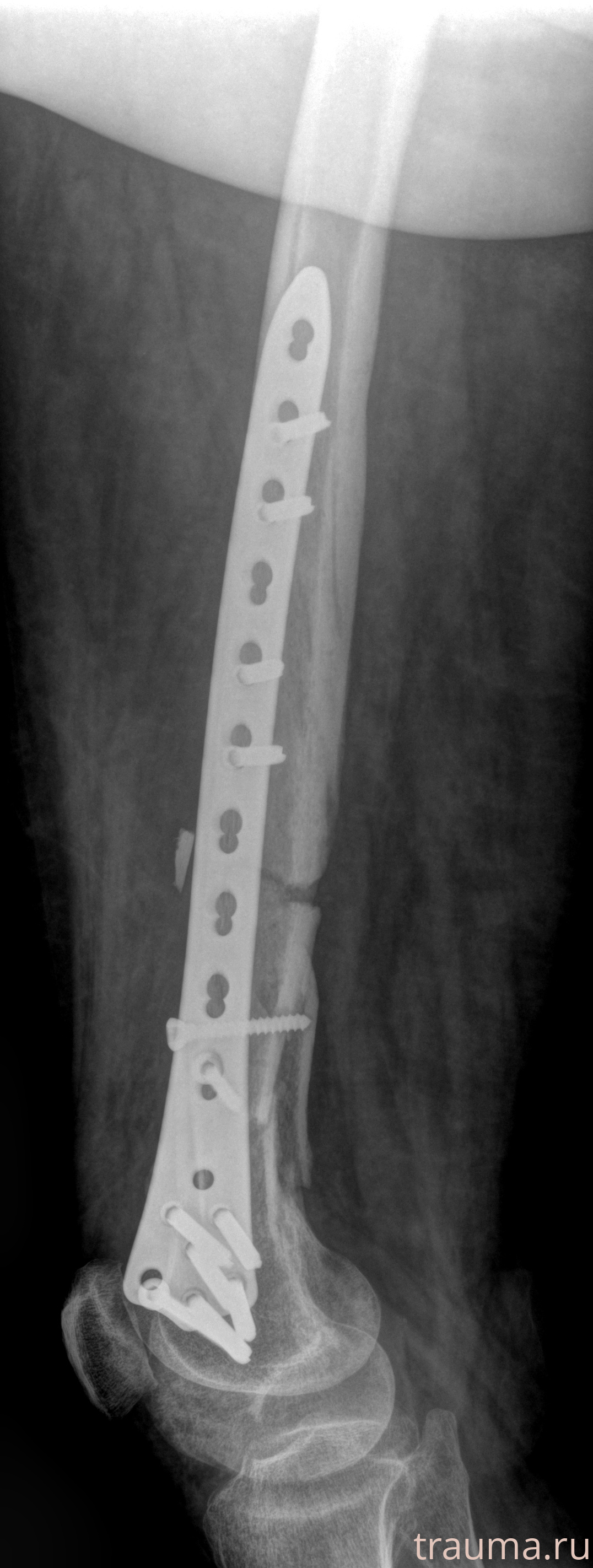 Рентген на дому: по вашему адресу приезжает врач-рентгенолог, травматолог-ортопед с мобильным рентгеновским аппаратом, проводит диагностику травмы или заболевания, делает необходимые рентгенограммы, дает рекомендации по дальнейшему лечению. Получить качественные снимки в домашних условиях возможно благодаря уникальной методике, разработанной МосРентген Центром для института  Склифосовского