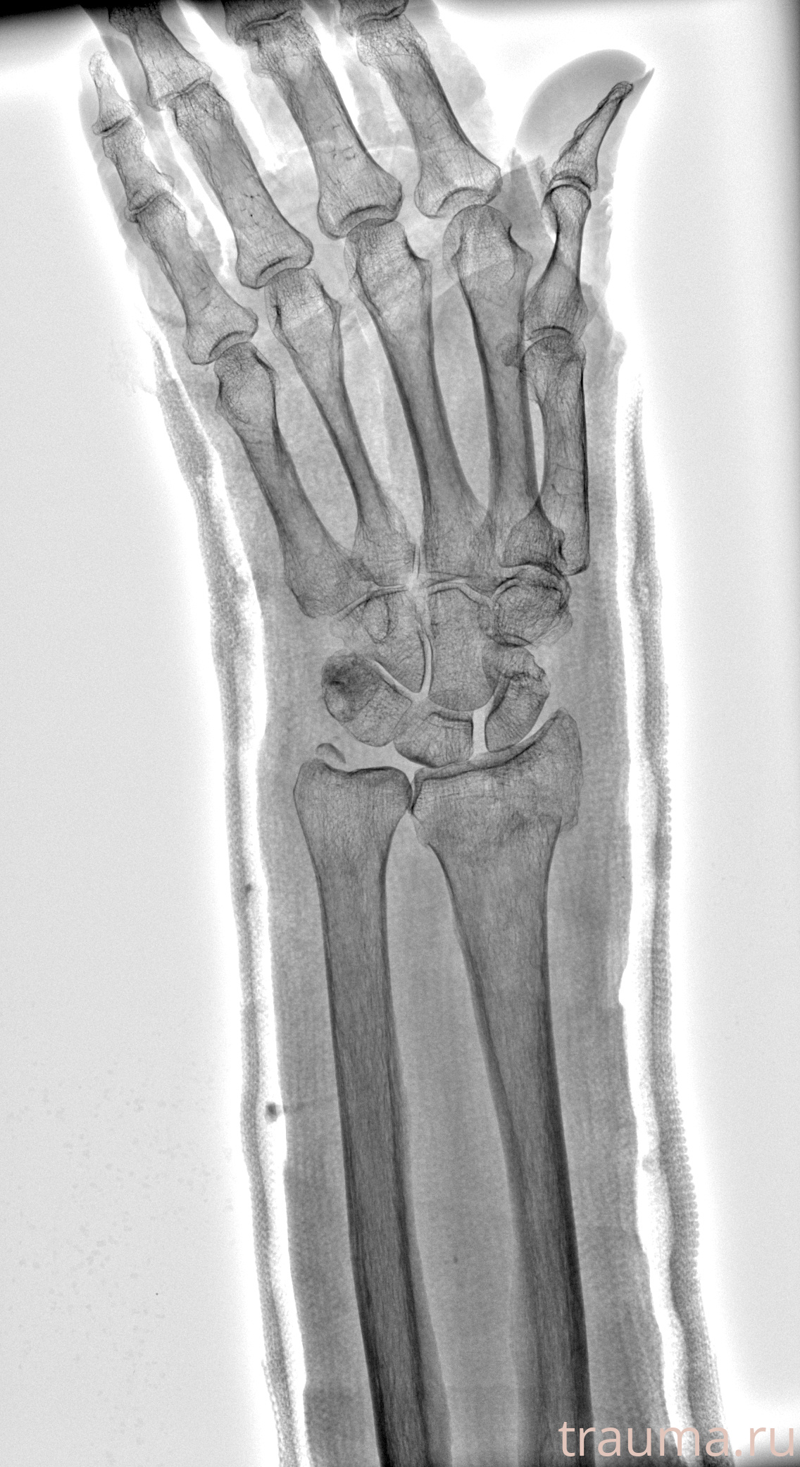 Рентген на дому: по вашему адресу приезжает врач-рентгенолог, травматолог-ортопед с мобильным рентгеновским аппаратом, проводит диагностику травмы или заболевания, делает необходимые рентгенограммы, дает рекомендации по дальнейшему лечению. Получить качественные снимки в домашних условиях возможно благодаря уникальной методике, разработанной МосРентген Центром для института  Склифосовского