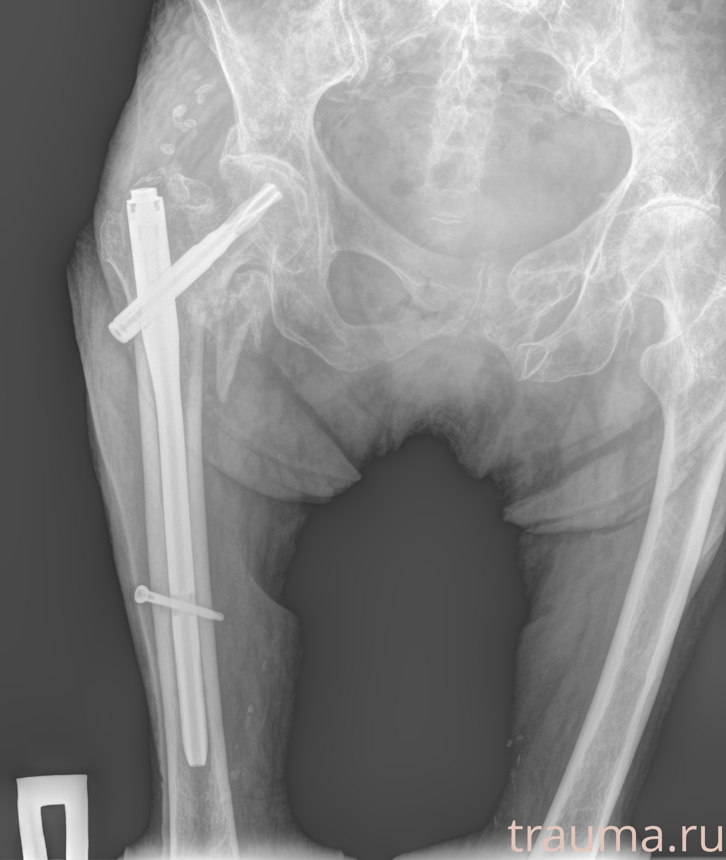 Рентген на дому: по вашему адресу приезжает врач-рентгенолог, травматолог-ортопед с мобильным рентгеновским аппаратом, проводит диагностику травмы или заболевания, делает необходимые рентгенограммы, дает рекомендации по дальнейшему лечению. Получить качественные снимки в домашних условиях возможно благодаря уникальной методике, разработанной МосРентген Центром для института  Склифосовского