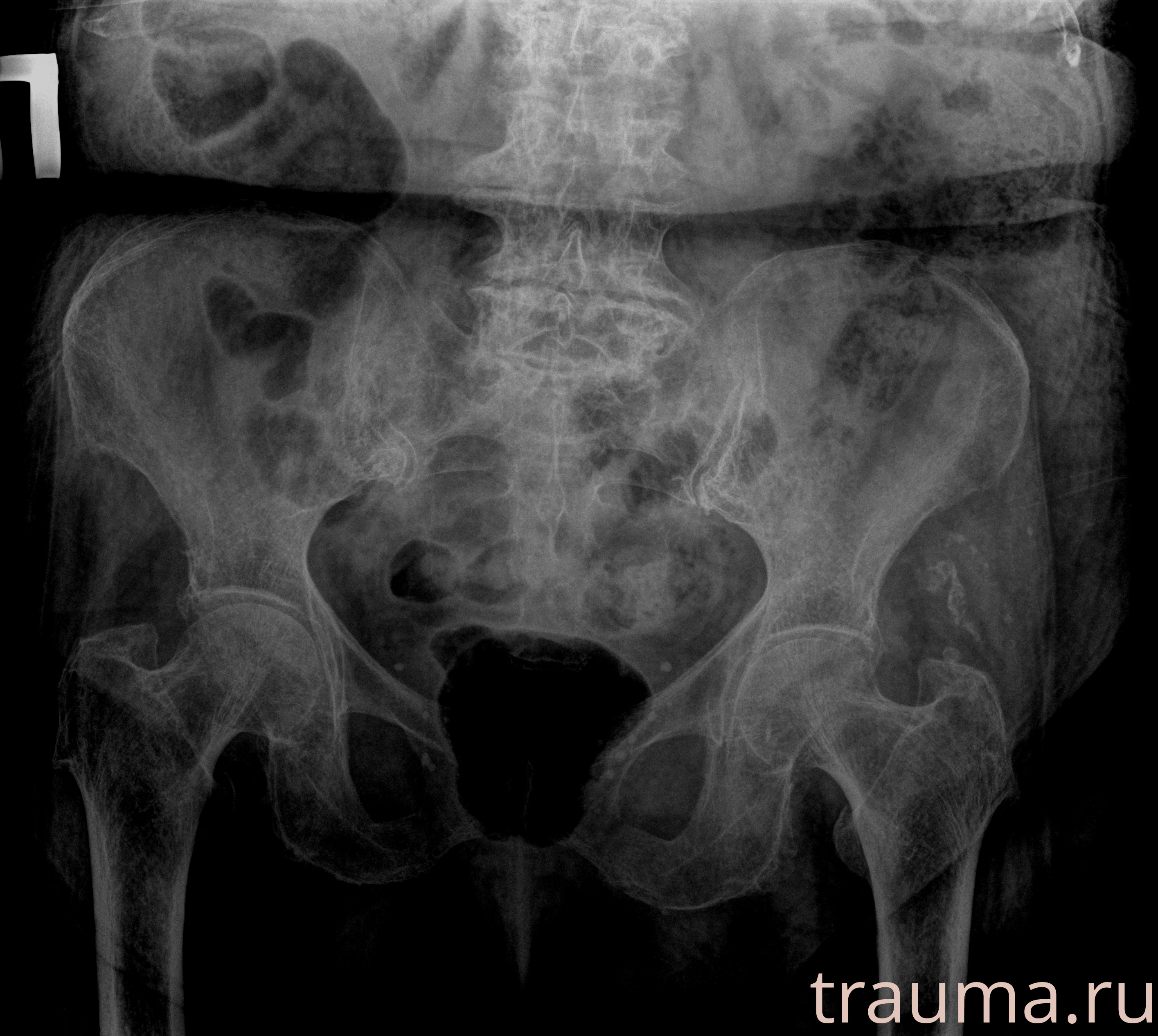 Рентген на дому: по вашему адресу приезжает врач-рентгенолог, травматолог-ортопед с мобильным рентгеновским аппаратом, проводит диагностику травмы или заболевания, делает необходимые рентгенограммы, дает рекомендации по дальнейшему лечению. Получить качественные снимки в домашних условиях возможно благодаря уникальной методике, разработанной МосРентген Центром для института  Склифосовского