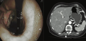 МРТ-диагностика рака желудка