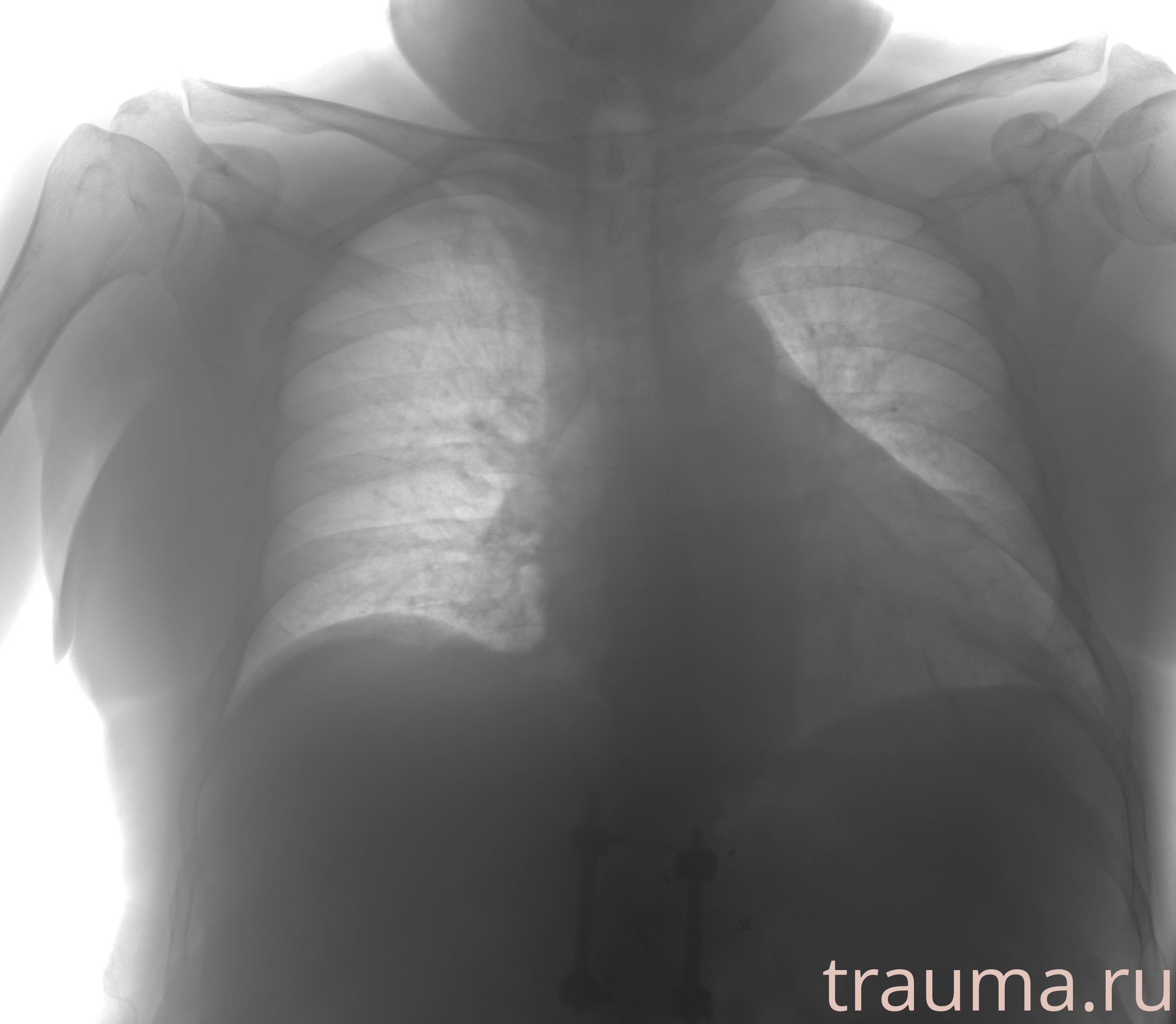 Рентген на дому: по вашему адресу приезжает врач-рентгенолог, травматолог-ортопед с мобильным рентгеновским аппаратом, проводит диагностику травмы или заболевания, делает необходимые рентгенограммы, дает рекомендации по дальнейшему лечению. Получить качественные снимки в домашних условиях возможно благодаря уникальной методике, разработанной МосРентген Центром для института  Склифосовского