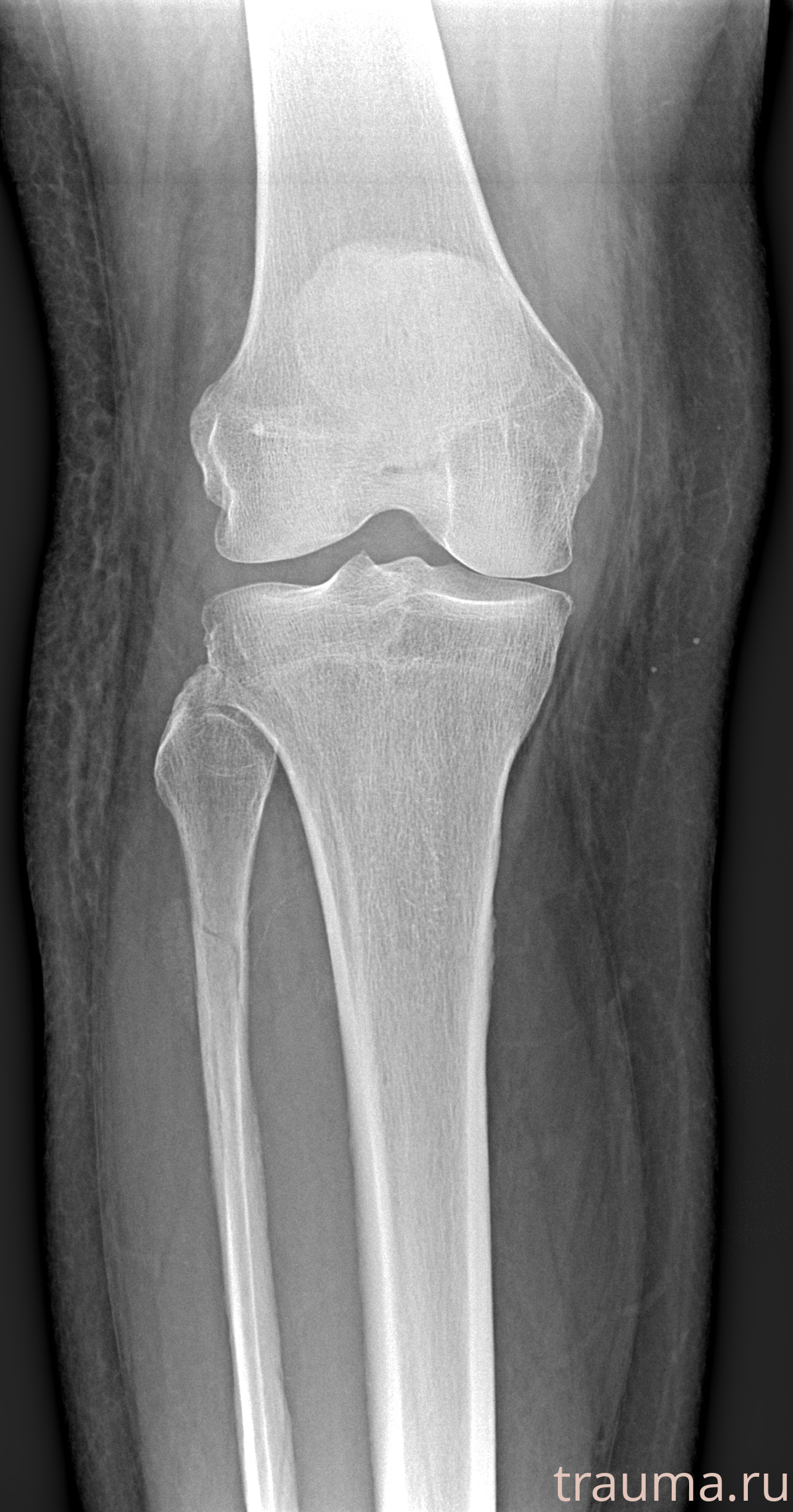 Рентген на дому: по вашему адресу приезжает врач-рентгенолог, травматолог-ортопед с мобильным рентгеновским аппаратом, проводит диагностику травмы или заболевания, делает необходимые рентгенограммы, дает рекомендации по дальнейшему лечению. Получить качественные снимки в домашних условиях возможно благодаря уникальной методике, разработанной МосРентген Центром для института  Склифосовского