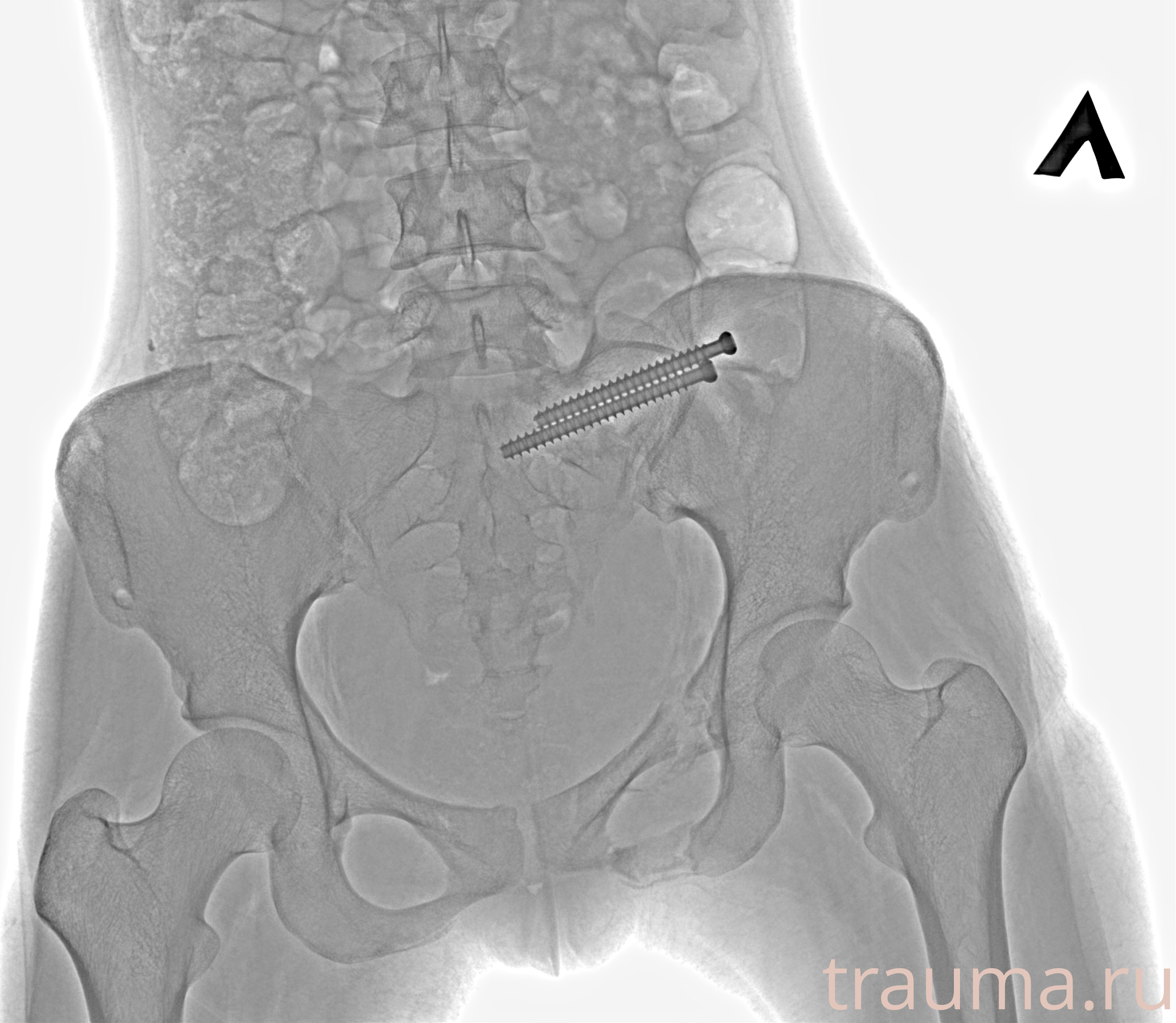 Рентген на дому: по вашему адресу приезжает врач-рентгенолог, травматолог-ортопед с мобильным рентгеновским аппаратом, проводит диагностику травмы или заболевания, делает необходимые рентгенограммы, дает рекомендации по дальнейшему лечению. Получить качественные снимки в домашних условиях возможно благодаря уникальной методике, разработанной МосРентген Центром для института  Склифосовского
