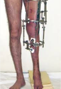 Сравнительная оценка результатов использования аппарата Илизарова и ортопедического гексапода при лечении пациентов со сгибательными контрактурами коленного сустава 