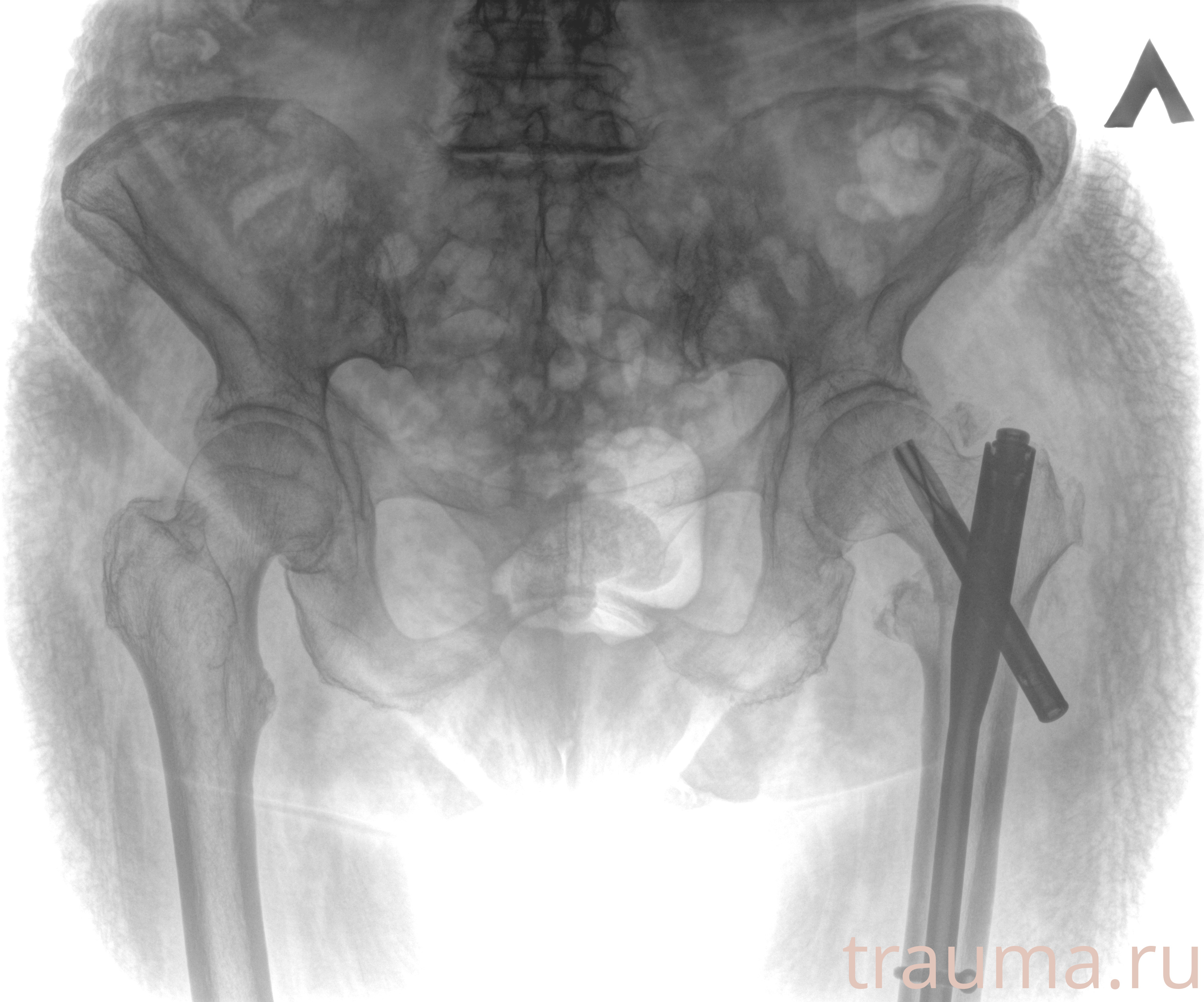 Рентген на дому: по вашему адресу приезжает врач-рентгенолог, травматолог-ортопед с мобильным рентгеновским аппаратом, проводит диагностику травмы или заболевания, делает необходимые рентгенограммы, дает рекомендации по дальнейшему лечению. Получить качественные снимки в домашних условиях возможно благодаря уникальной методике, разработанной МосРентген Центром для института  Склифосовского