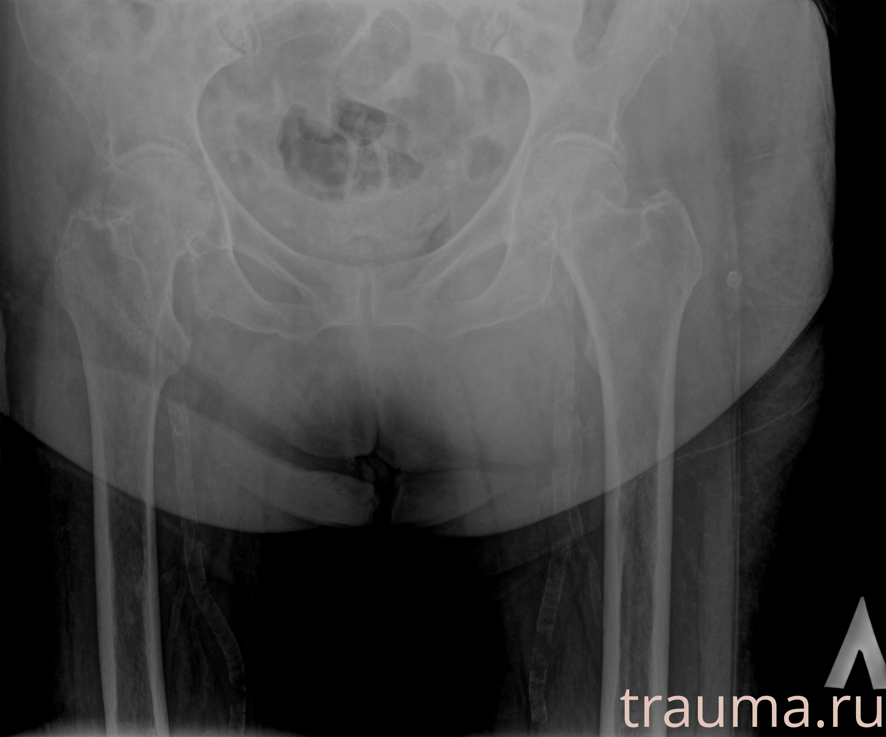 Рентген на дому: по вашему адресу приезжает врач-рентгенолог, травматолог-ортопед с мобильным рентгеновским аппаратом, проводит диагностику травмы или заболевания, делает необходимые рентгенограммы, дает рекомендации по дальнейшему лечению. Получить качественные снимки в домашних условиях возможно благодаря уникальной методике, разработанной МосРентген Центром для института  Склифосовского