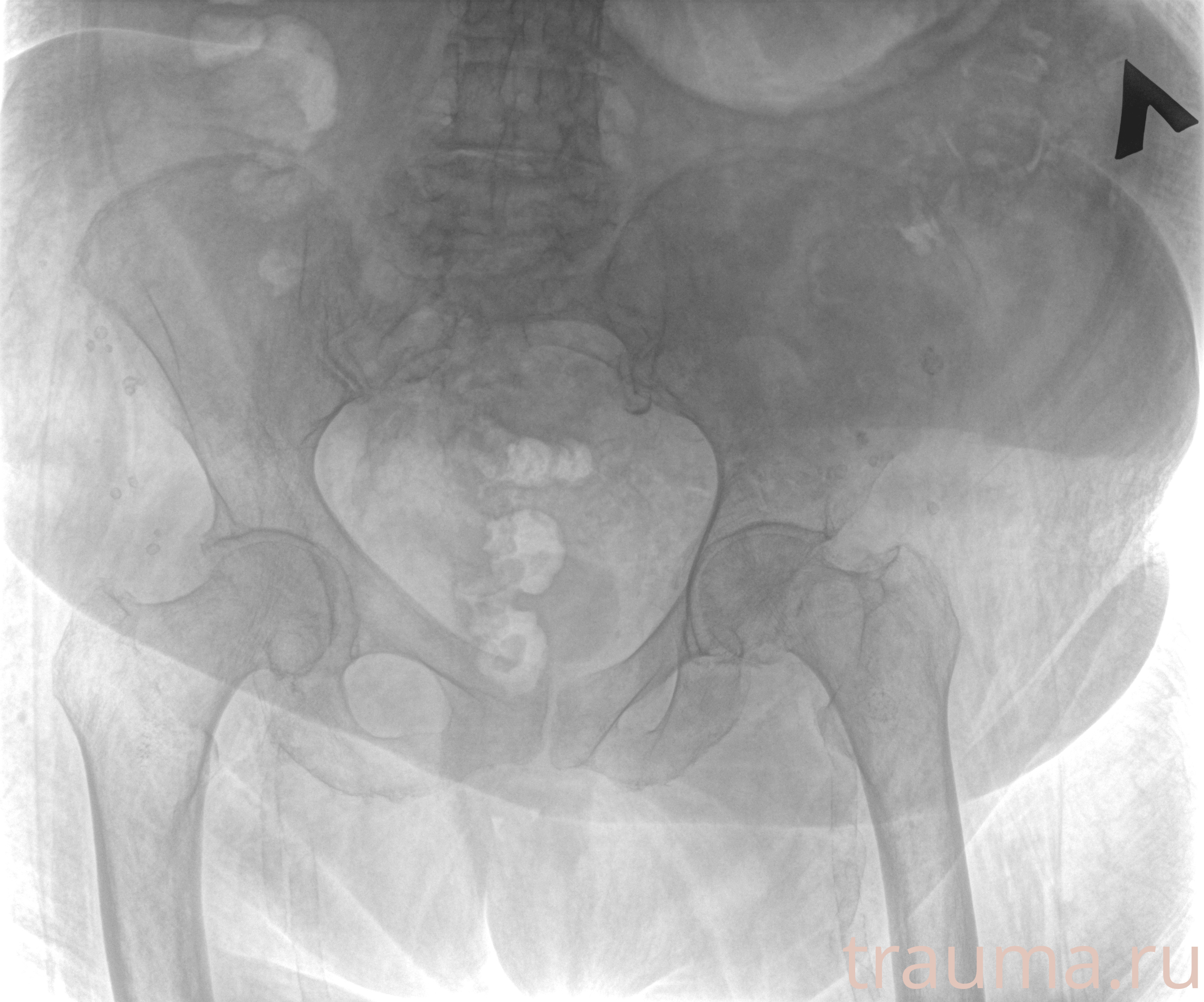 Рентген на дому: по вашему адресу приезжает врач-рентгенолог, травматолог-ортопед с мобильным рентгеновским аппаратом, проводит диагностику травмы или заболевания, делает необходимые рентгенограммы, дает рекомендации по дальнейшему лечению. Получить качественные снимки в домашних условиях возможно благодаря уникальной методике, разработанной МосРентген Центром для института  Склифосовского