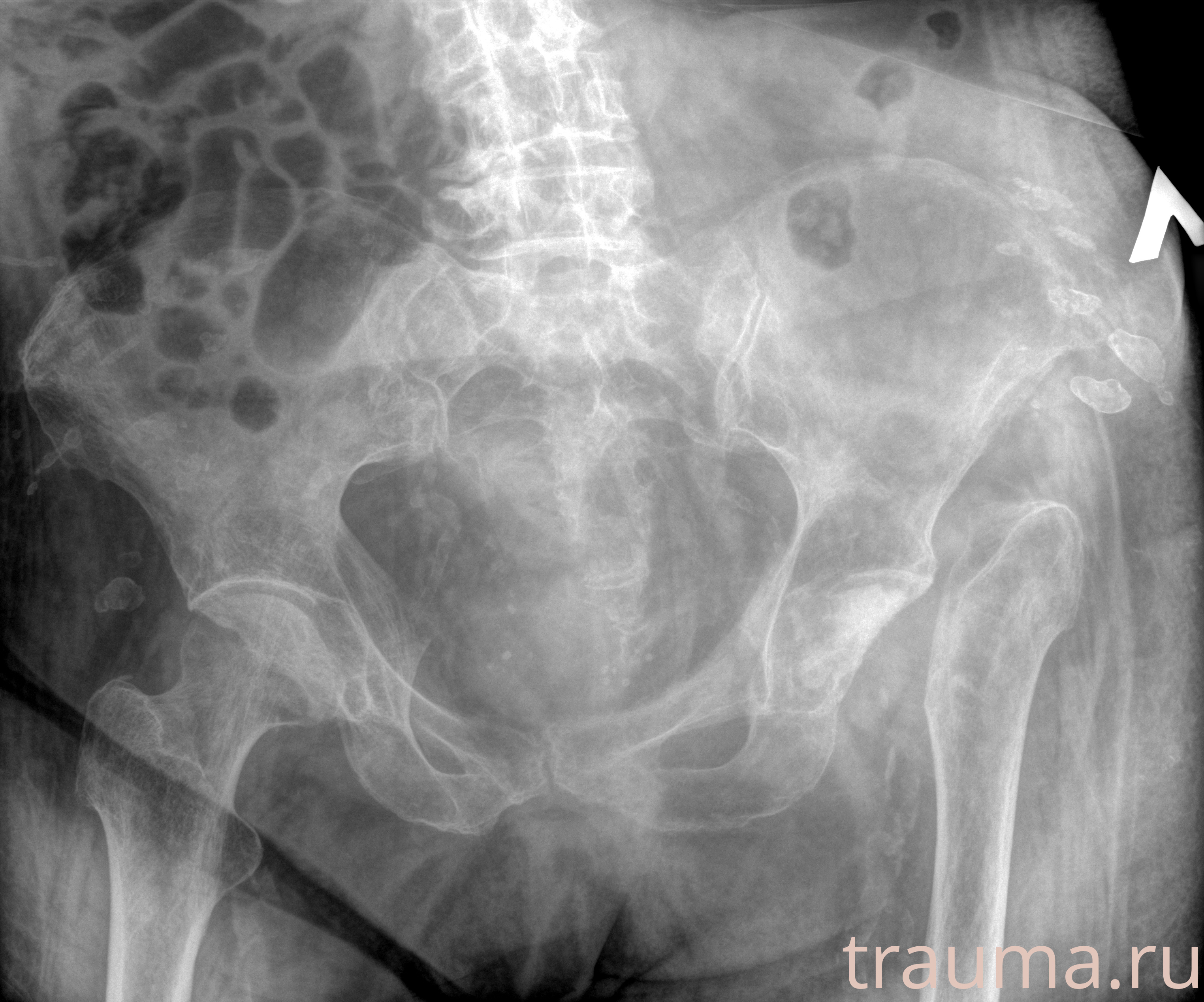 Рентген на дому: по вашему адресу приезжает врач-рентгенолог, травматолог-ортопед с мобильным рентгеновским аппаратом, проводит диагностику травмы или заболевания, делает необходимые рентгенограммы, дает рекомендации по дальнейшему лечению. Получить качественные снимки в домашних условиях возможно благодаря уникальной методике, разработанной МосРентген Центром для института  Склифосовского