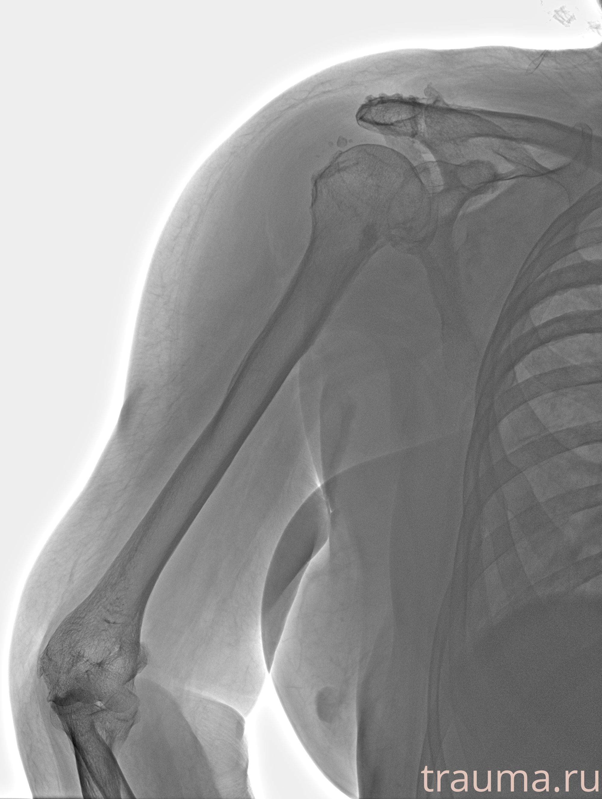 Рентген на дому: по вашему адресу приезжает врач-рентгенолог, травматолог-ортопед с мобильным рентгеновским аппаратом, проводит диагностику травмы или заболевания, делает необходимые рентгенограммы, дает рекомендации по дальнейшему лечению. Получить качественные снимки в домашних условиях возможно благодаря уникальной методике, разработанной МосРентген Центром для института  Склифосовского