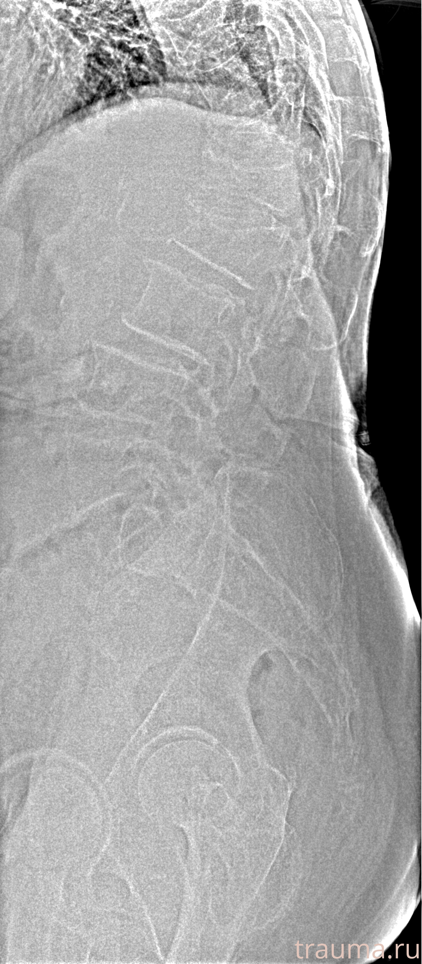 Рентген на дому: по вашему адресу приезжает врач-рентгенолог, травматолог-ортопед с мобильным рентгеновским аппаратом, проводит диагностику травмы или заболевания, делает необходимые рентгенограммы, дает рекомендации по дальнейшему лечению. Получить качественные снимки в домашних условиях возможно благодаря уникальной методике, разработанной МосРентген Центром для института  Склифосовского