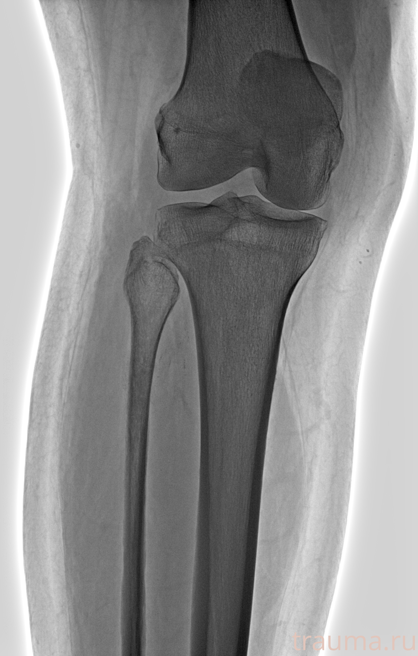 Рентген на дому: по вашему адресу приезжает врач-рентгенолог, травматолог-ортопед с мобильным рентгеновским аппаратом, проводит диагностику травмы или заболевания, делает необходимые рентгенограммы, дает рекомендации по дальнейшему лечению. Получить качественные снимки в домашних условиях возможно благодаря уникальной методике, разработанной МосРентген Центром для института  Склифосовского